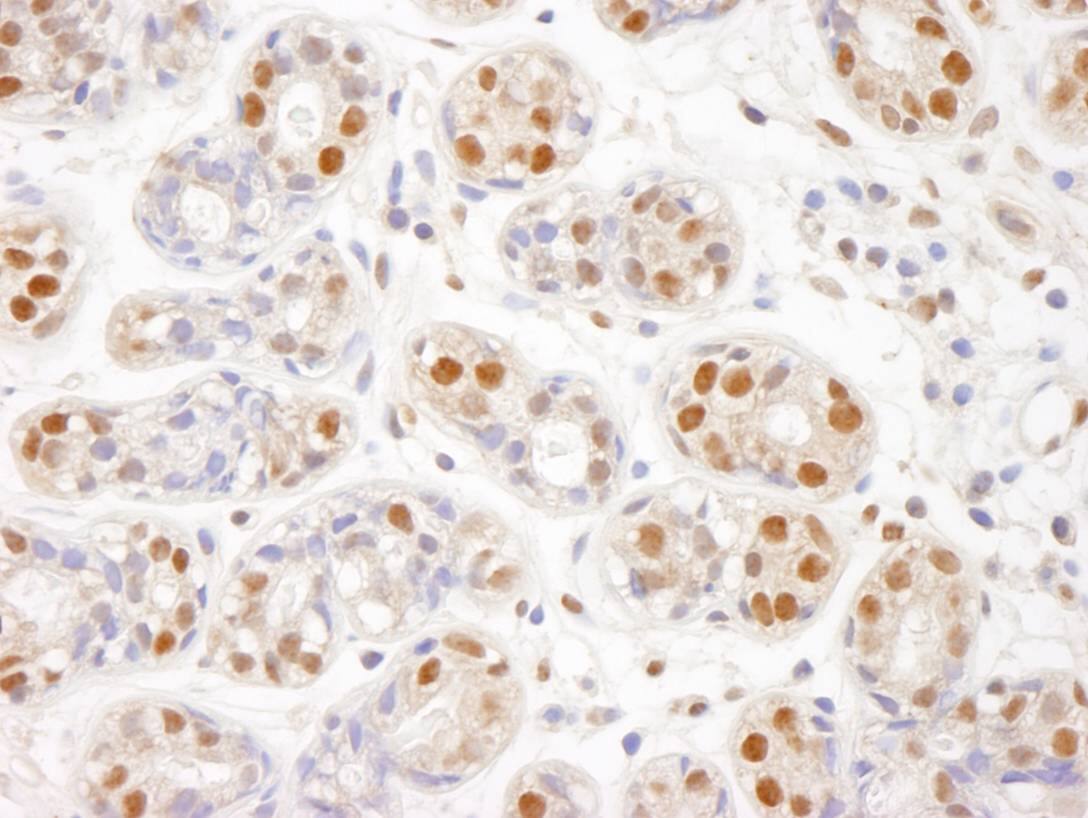 Immunohistochemistry:[NBP3-29226]-Detection of human SMC1 by immunohistochemistry. Sample: FFPE section of human breast. Antibody: Affinity purified rabbit anti-SMC1.