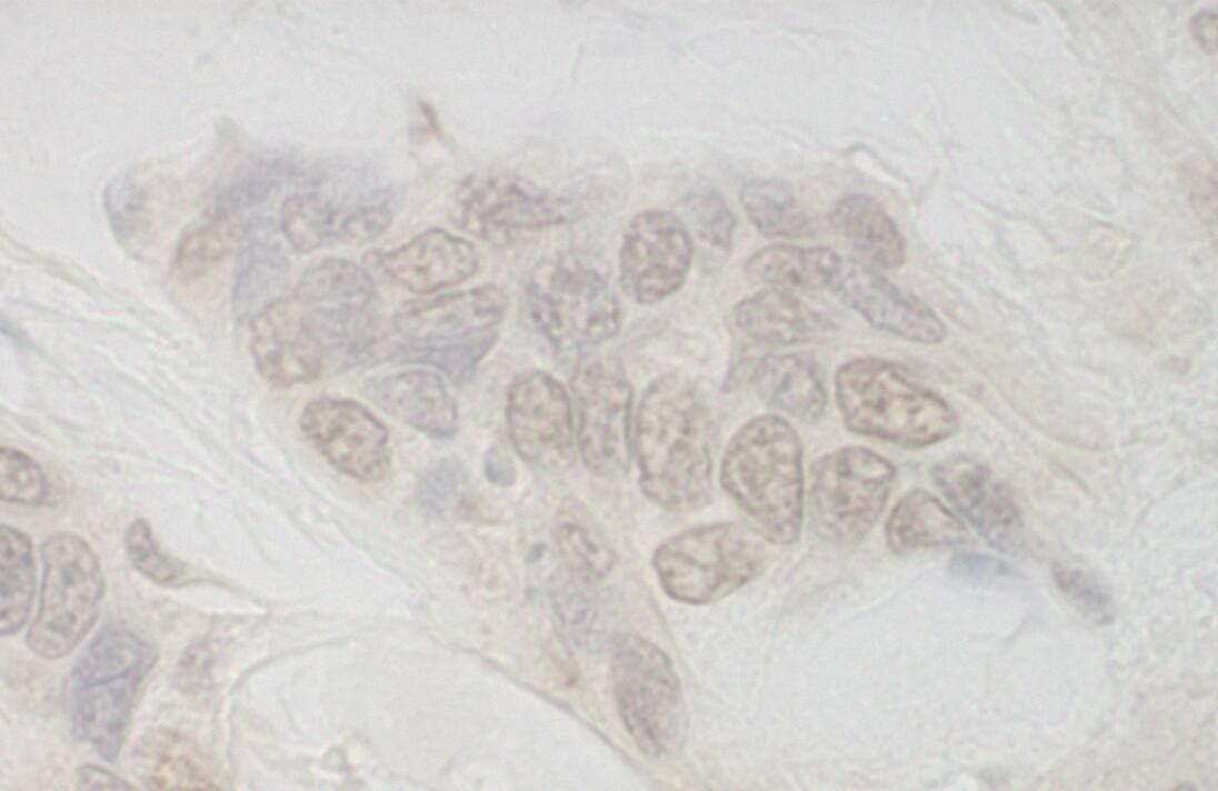 Immunohistochemistry:[NBP3-29233]-Detection of human IBP160 by immunohistochemistry. Sample: FFPE section of human ovarian carcinoma. Antibody: Affinity purified rabbit anti-IBP160.