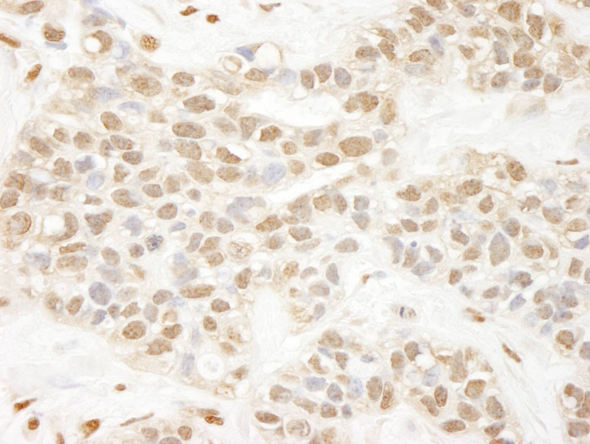 Immunohistochemistry:[NBP3-29235]-Detection of human Pc2 by immunohistochemistry. Sample: FFPE section of human breast carcinoma. Antibody: Affinity purified rabbit anti-Pc2.