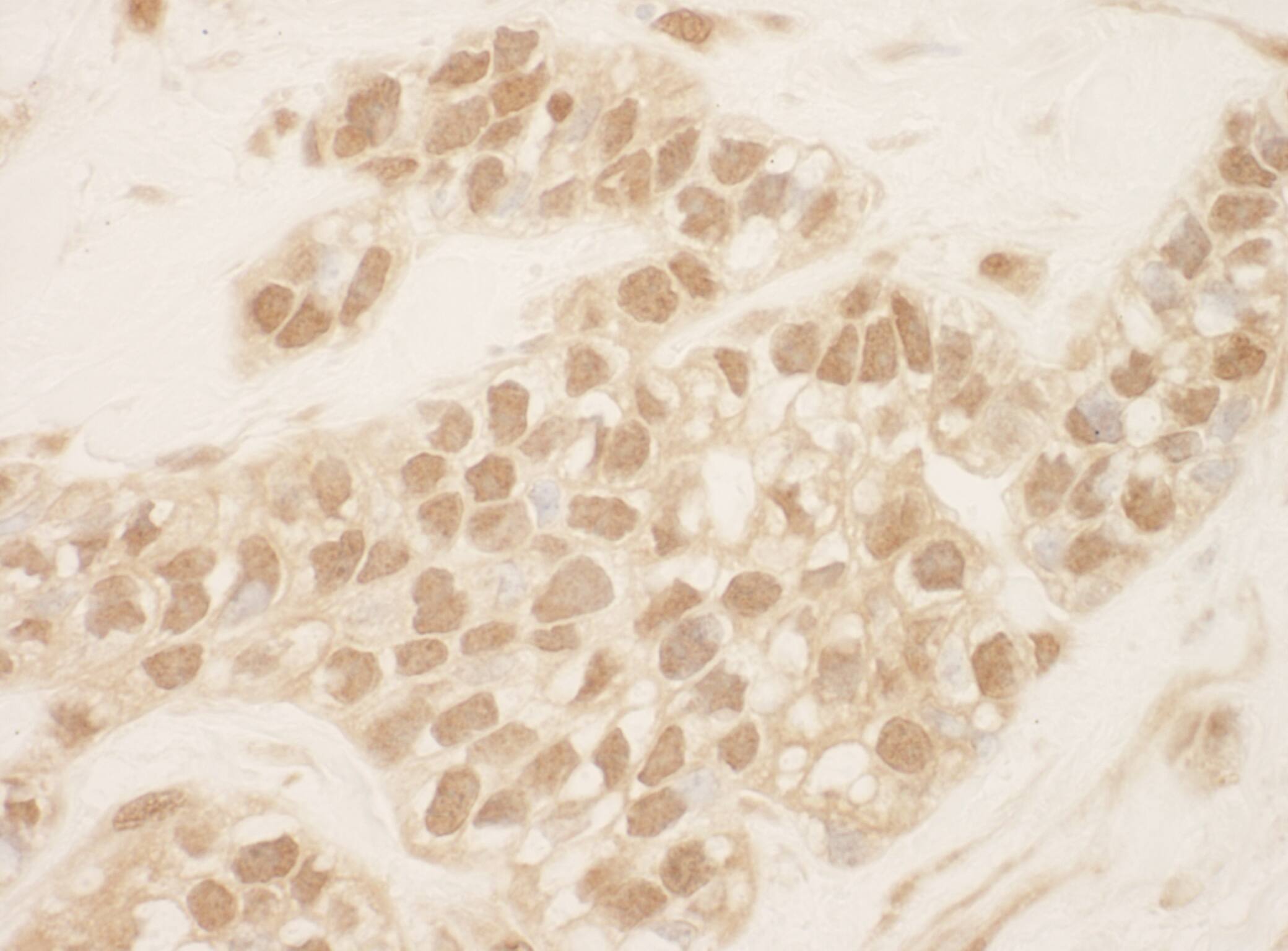 Immunohistochemistry:[NBP3-29236]-Detection of human Cul2 by immunohistochemistry. Sample: FFPE section of human breast carcinoma. Antibody: Affinity purified rabbit anti-Cul2.