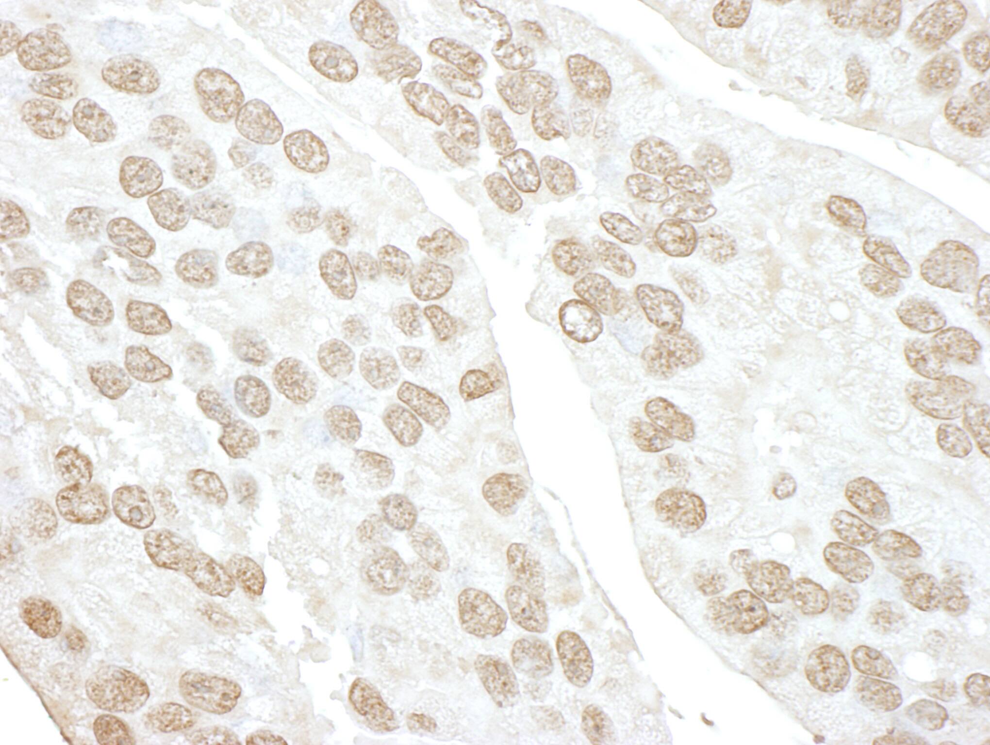 Immunohistochemistry:[NBP3-29237]-Detection of human POLR3D by immunohistochemistry. Sample: FFPE section of human prostate carcinoma. Antibody: Affinity purified rabbit anti-POLR3D.