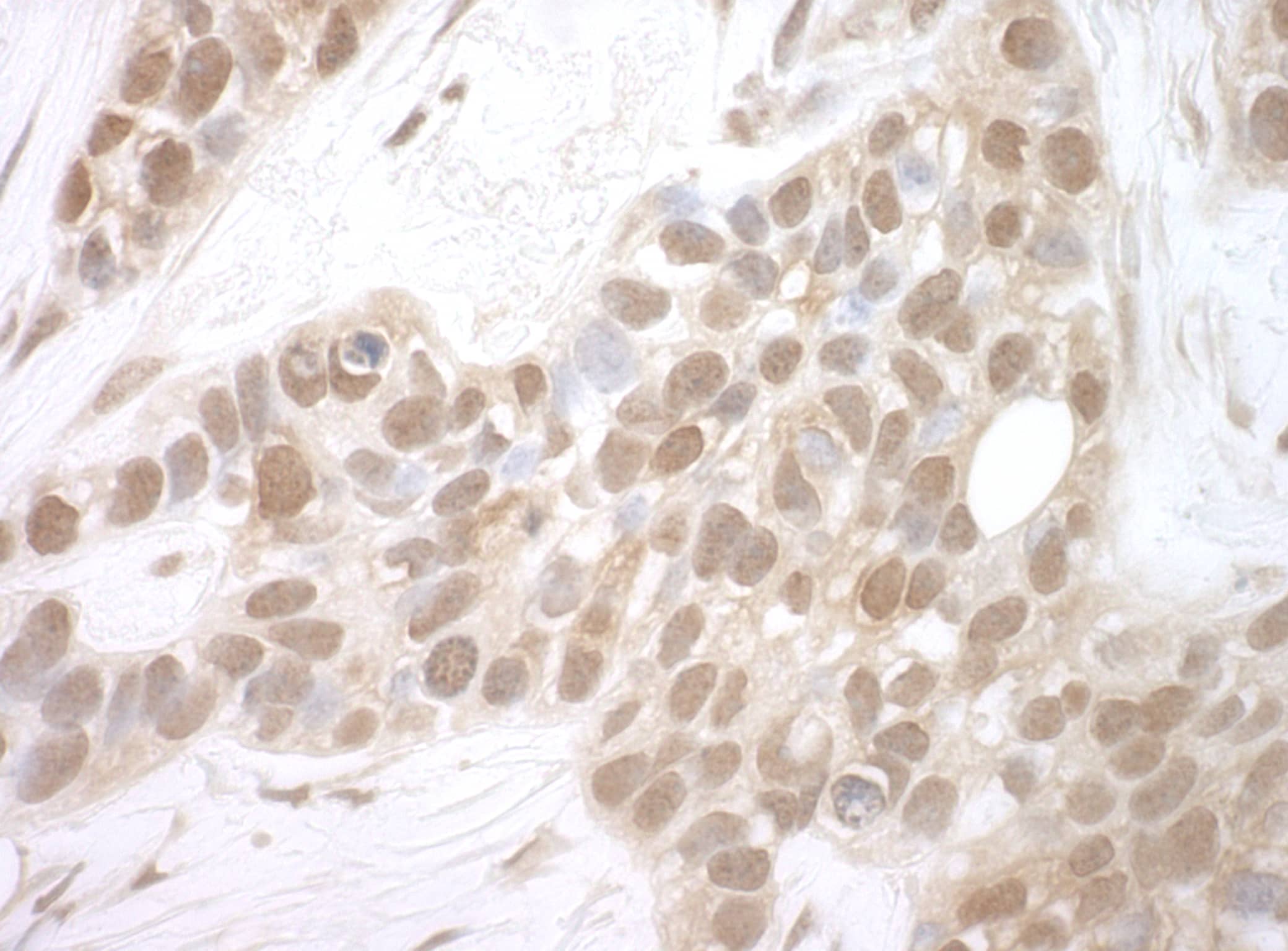 Immunohistochemistry:[NBP3-29241]-Detection of human MERIT40 by immunohistochemistry. Sample: FFPE section of human breast carcinoma. Antibody: Affinity purified rabbit anti-MERIT40.