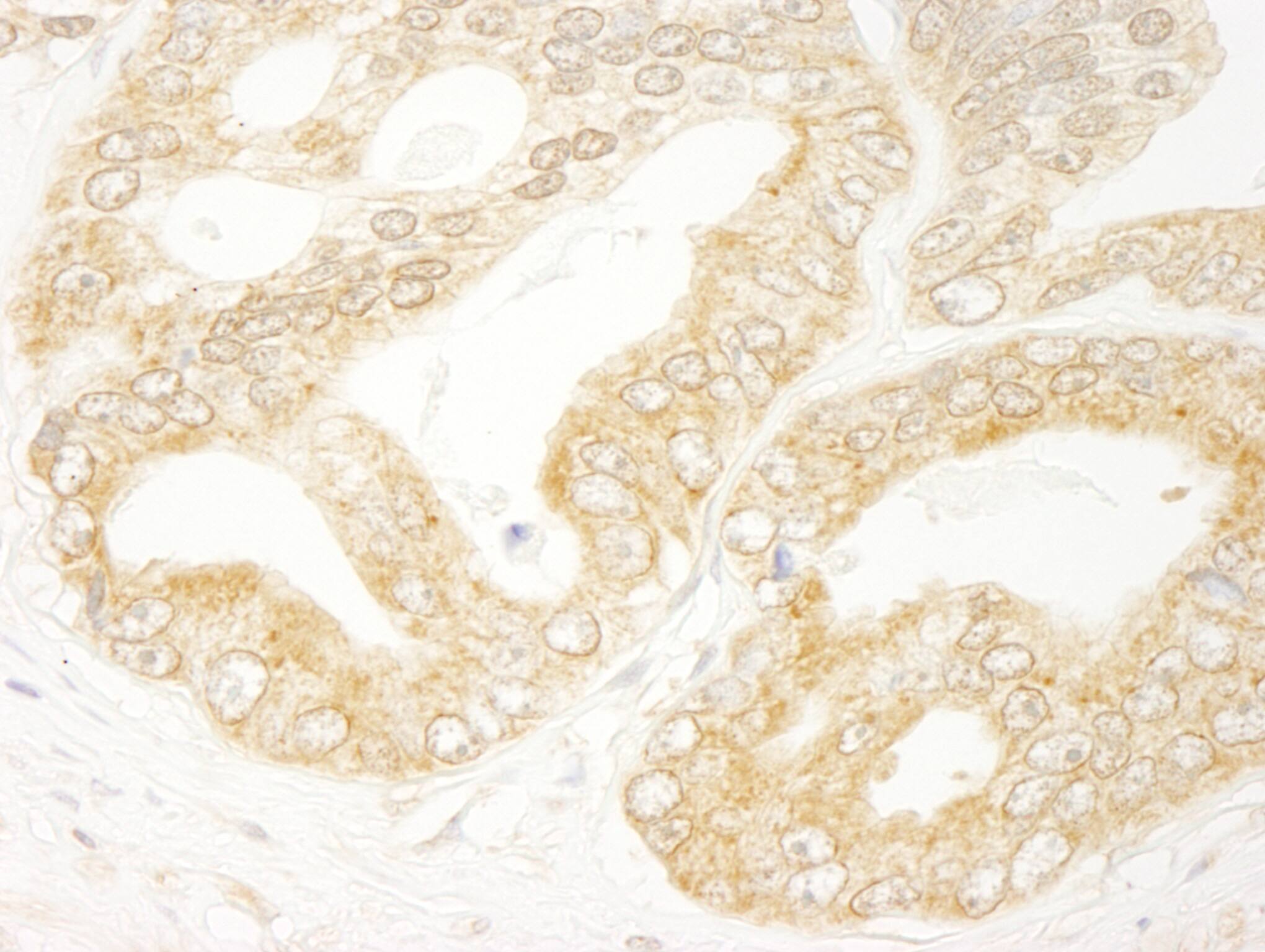 Immunohistochemistry:[NBP3-29242]-Detection of human eIF4H by immunohistochemistry. Sample: FFPE section of human prostate carcinoma. Antibody: Affinity purified rabbit anti-eIF4H.