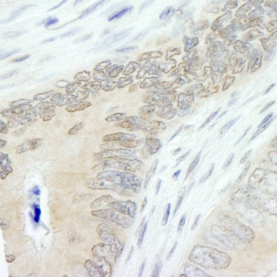 Immunohistochemistry:[NBP3-29248]-Detection of human Lasu1/Ureb1 by immunohistochemistry. Sample: FFPE section of human colon carcinoma. Antibody: Affinity purified rabbit anti-Lasu1/Ureb1.