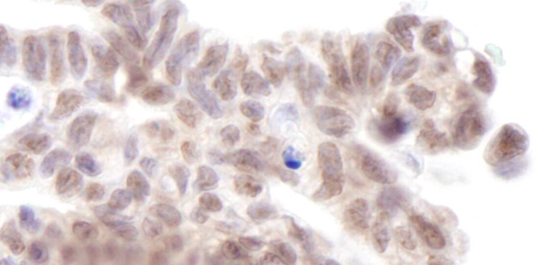 Immunohistochemistry:[NBP3-29249]-Detection of human AF9 by immunohistochemistry. Sample: FFPE section of human ovarian carcinoma. Antibody: Affinity purified rabbit anti-AF9.
