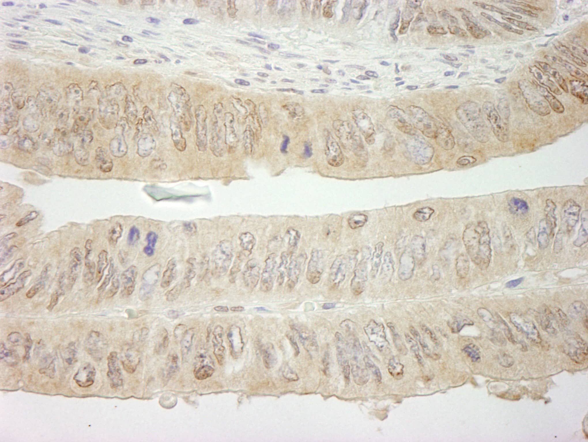 Immunohistochemistry:[NBP3-29250]-Detection of human SYK by immunohistochemistry. Sample: FFPE section of human colon carcinoma. Antibody: Affinity purified rabbit anti-SYK.