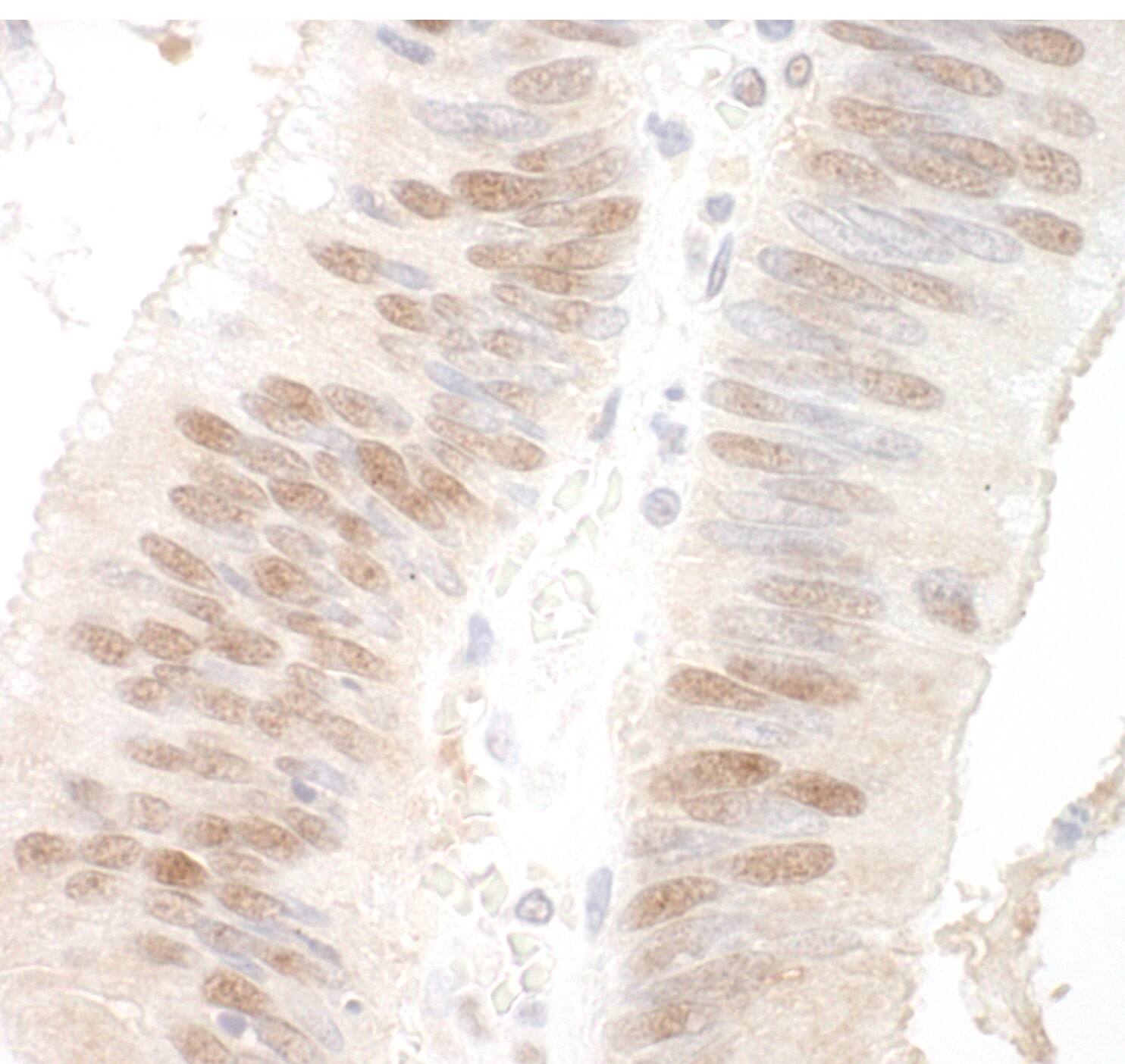 Immunohistochemistry:[NBP3-29255]-Detection of human MBD3 by immunohistochemistry. Sample: FFPE section of human colon carcinoma. Antibody: Affinity purified rabbit anti-MBD3.