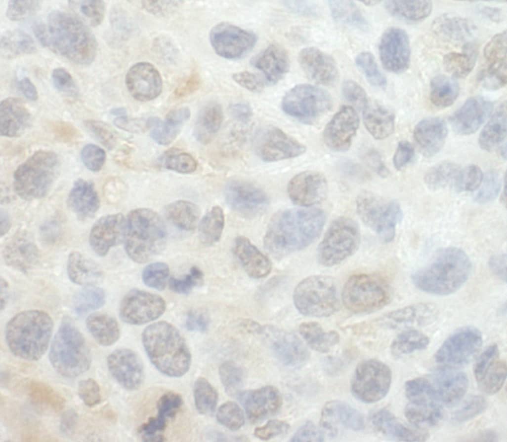 Immunohistochemistry:[NBP3-29256]-Detection of mouse SRPK1 by immunohistochemistry. Sample: FFPE section of mouse CT26 tumor. Antibody: Affinity purified rabbit anti-SRPK1.