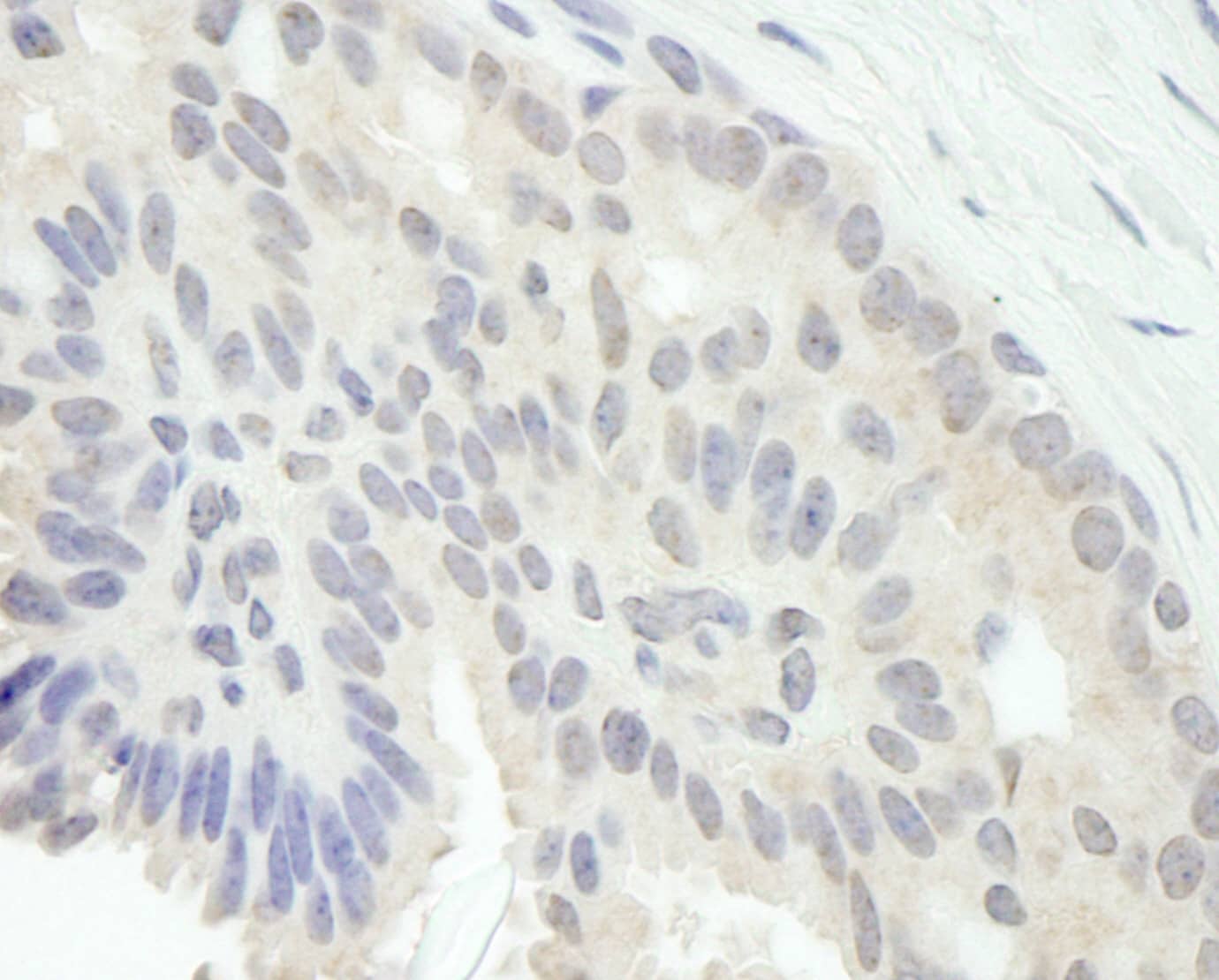 Immunohistochemistry:[NBP3-29259]-Detection of human E2F1 by immunohistochemistry. Sample: FFPE section of human breast carcinoma. Antibody: Affinity purified rabbit anti-E2F1.