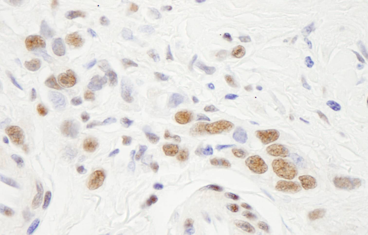 Immunohistochemistry:[NBP3-29265]-Detection of human NF-YA by immunohistochemistry. Sample: FFPE section of human Linitis Plastica stomach cancer. Antibody: Affinity purified rabbit.