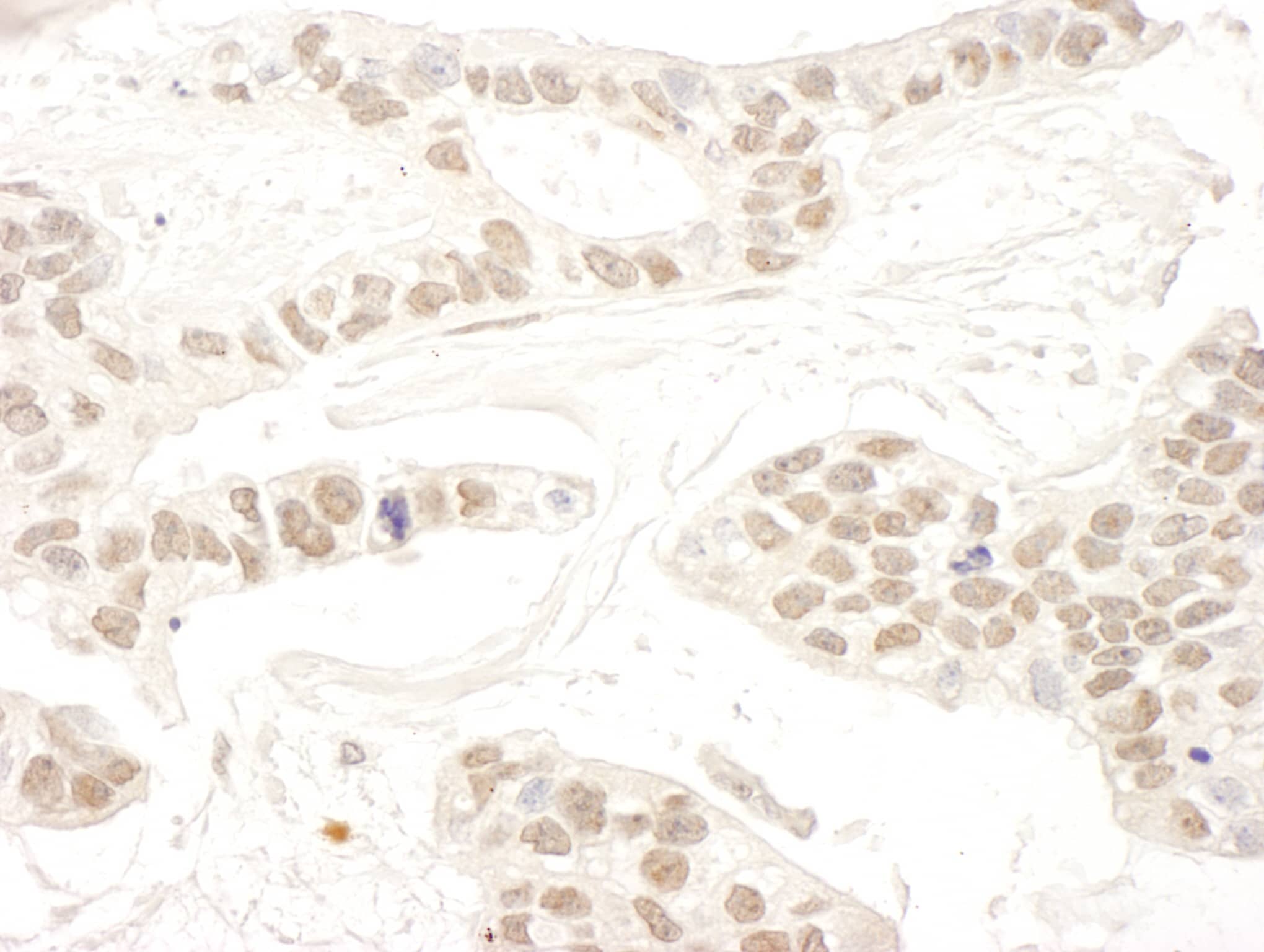 Immunohistochemistry:[NBP3-29268]-Detection of human RBM34 by immunohistochemistry. Sample: FFPE section of human breast carcinoma. Antibody: Affinity purified rabbit anti-RBM34.