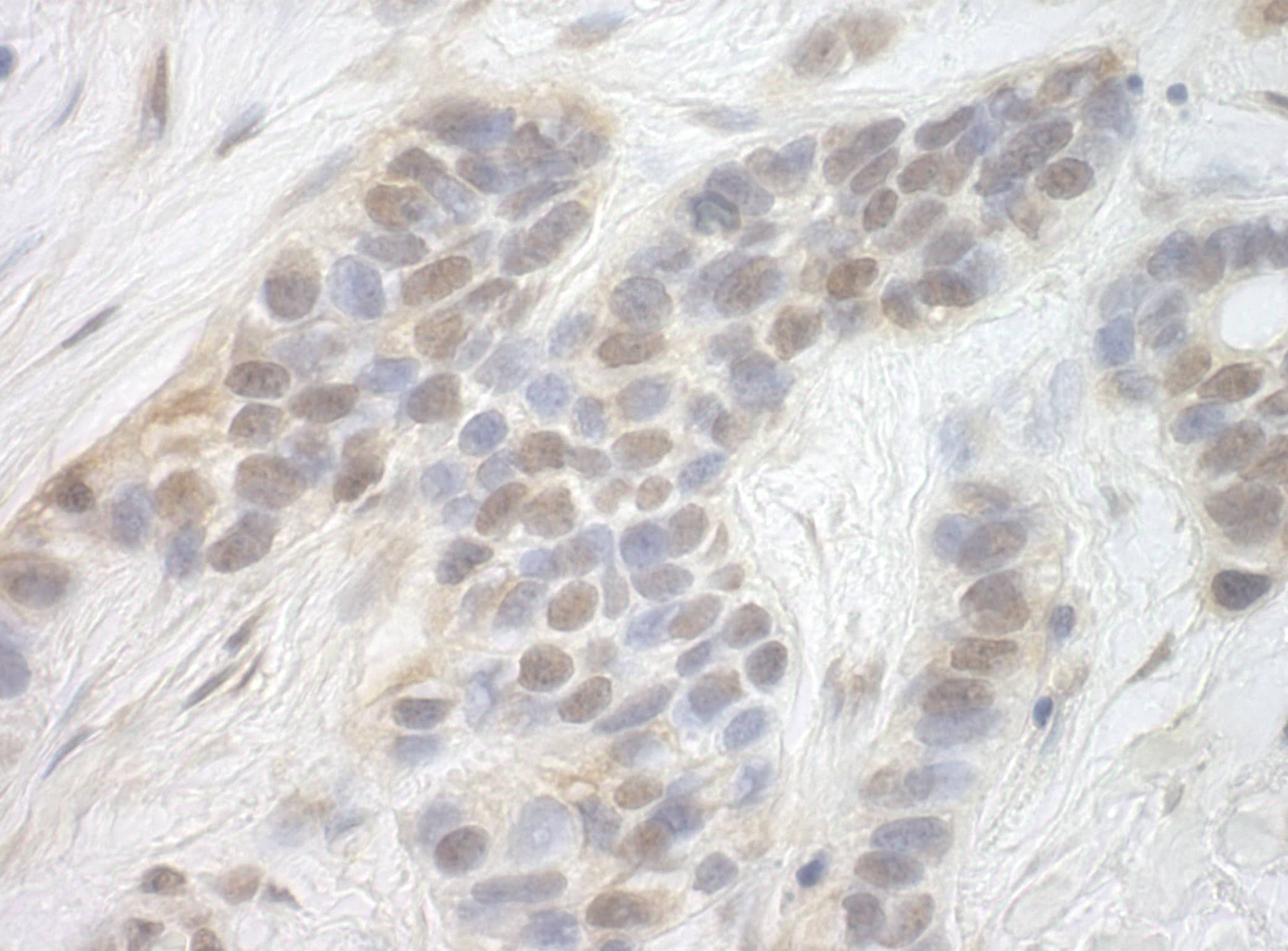 Immunohistochemistry:[NBP3-29273]-Detection of human CDK8 by immunohistochemistry. Sample: FFPE section of human breast carcinoma. Antibody: Affinity purified rabbit anti-CDK8.