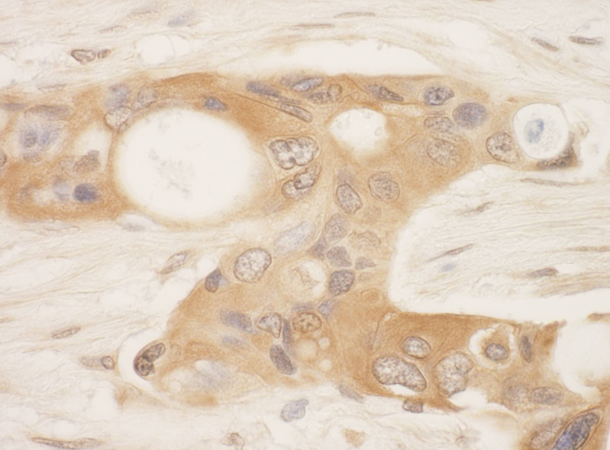 Immunohistochemistry:[NBP3-29274]-Detection of human SPAK by immunohistochemistry. Sample: FFPE section of human ovarian carcinoma. Antibody: Affinity purified rabbit anti-SPAK.