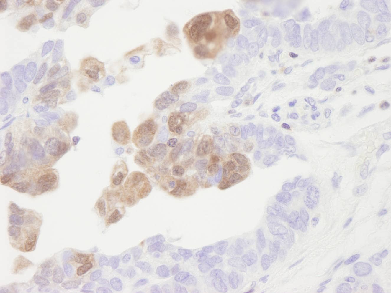 Immunohistochemistry:[NBP3-29275]-Detection of human CamK4 by immunohistochemistry. Sample: FFPE section of human ovarian tumor. Antibody: Affinity purified rabbit anti-CamK4.