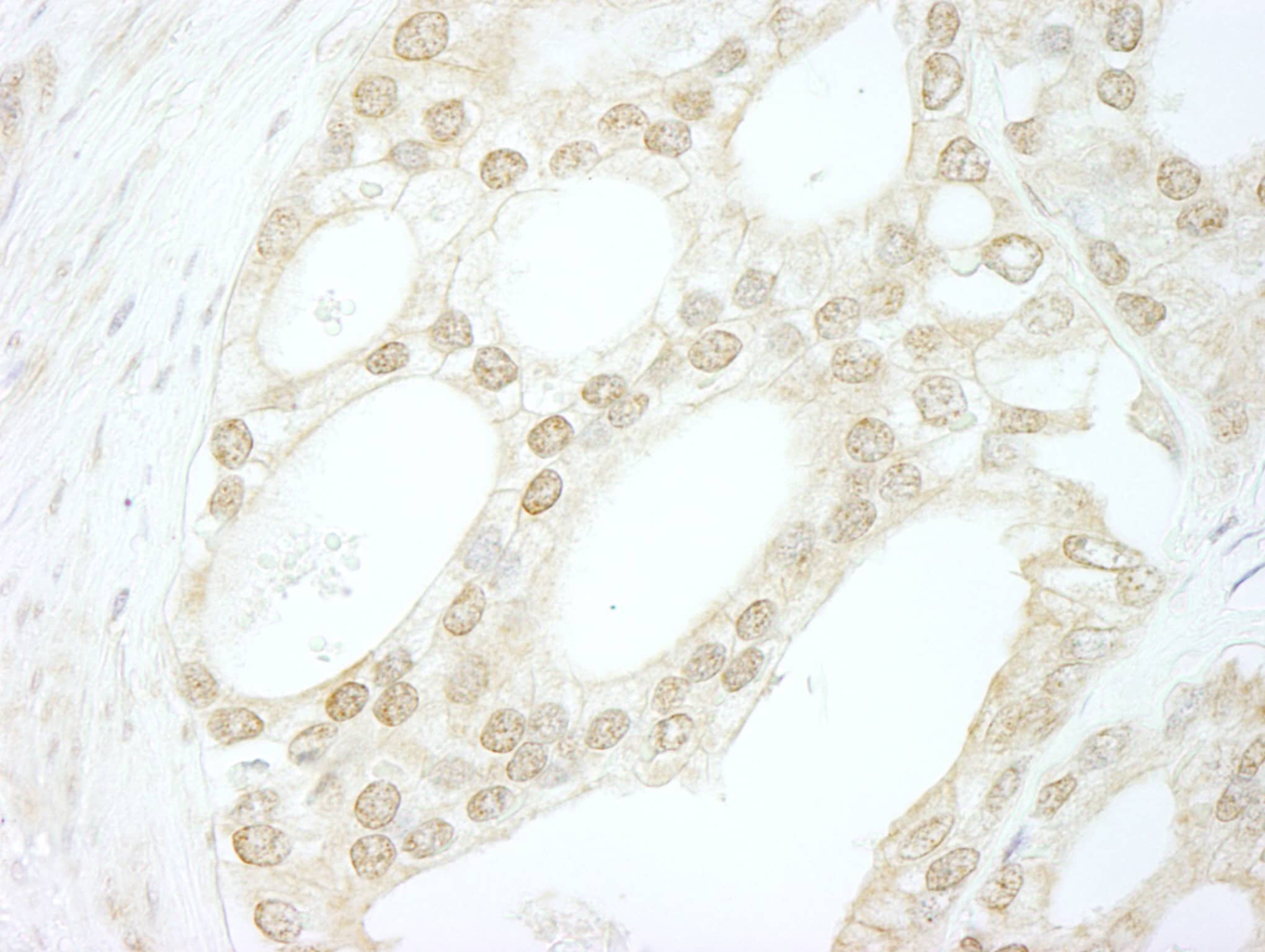 Immunohistochemistry:[NBP3-29277]-Detection of human B-Myb by immunohistochemistry. Sample: FFPE section of human prostate carcinoma. Antibody: Affinity purified rabbit anti-B-Myb.
