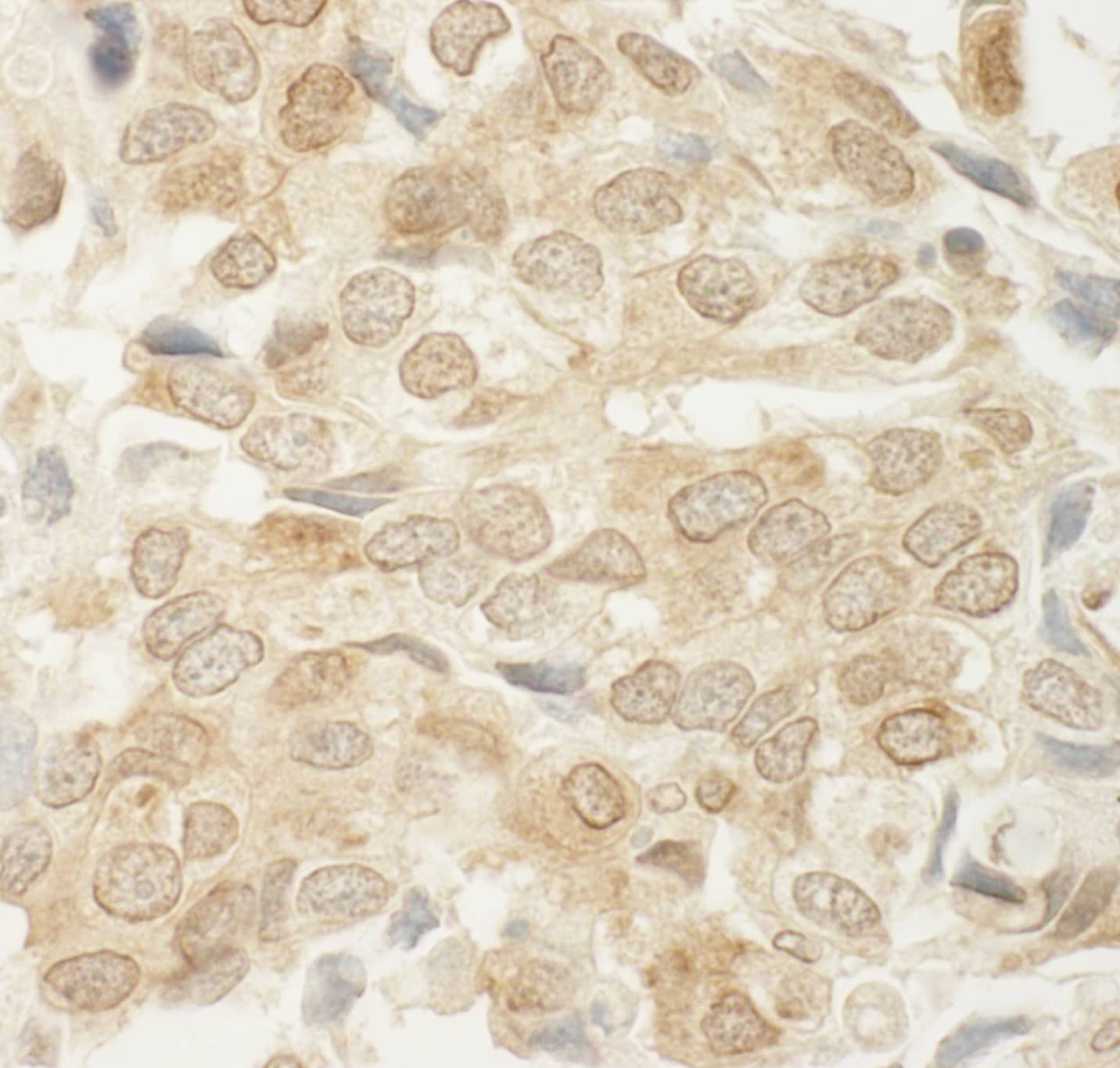 Immunohistochemistry:[NBP3-29282]-Detection of human MED15 by immunohistochemistry. Sample: FFPE section of human breast carcinoma. Antibody: Affinity purified rabbit anti-MED15.