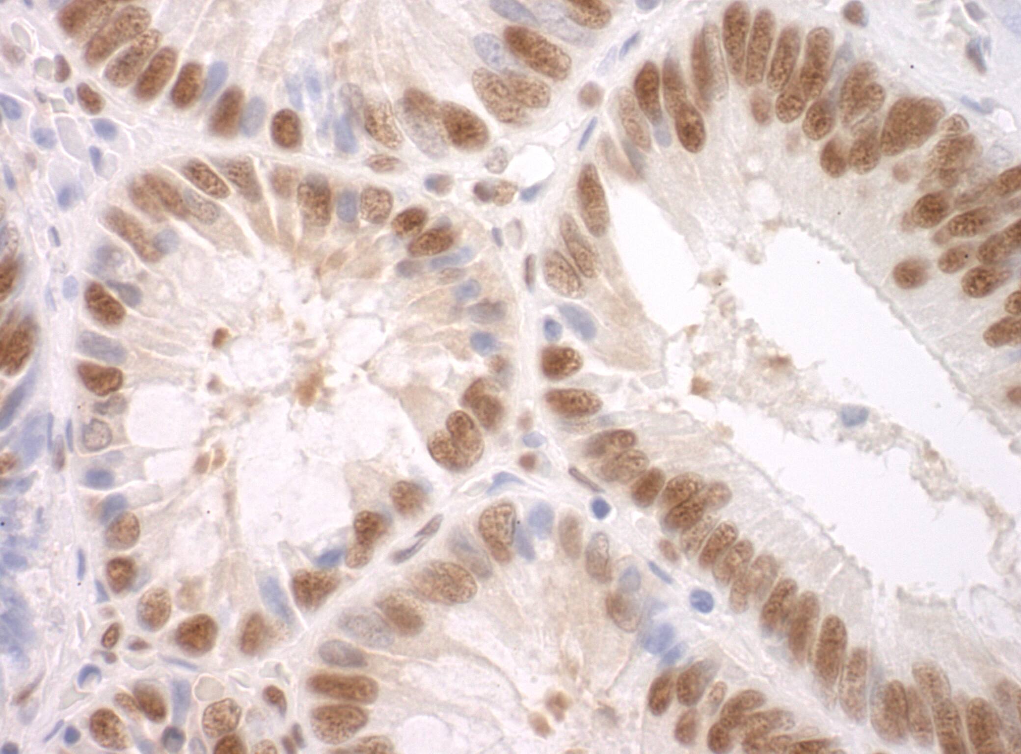 Immunohistochemistry:[NBP3-29283]-Detection of human SF3A3 by immunohistochemistry. Sample: FFPE section of human colon carcinoma. Antibody: Affinity purified rabbit anti-SF3A3.