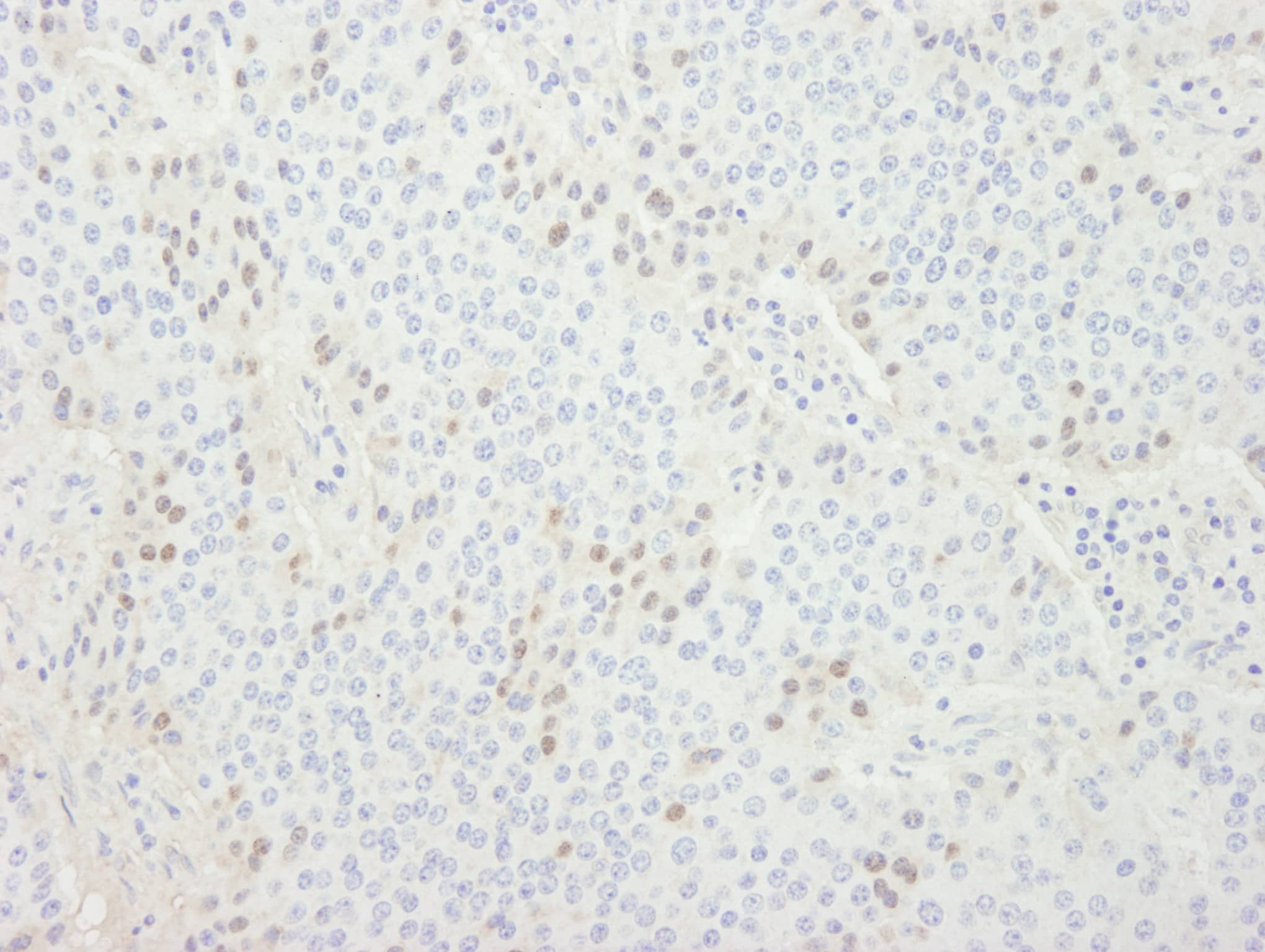 Immunohistochemistry:[NBP3-29285]-Detection of human CDT1 by immunohistochemistry. Sample: FFPE section of human pancreatic islet cell tumor. Antibody: Affinity purified rabbit anti-CDT1.