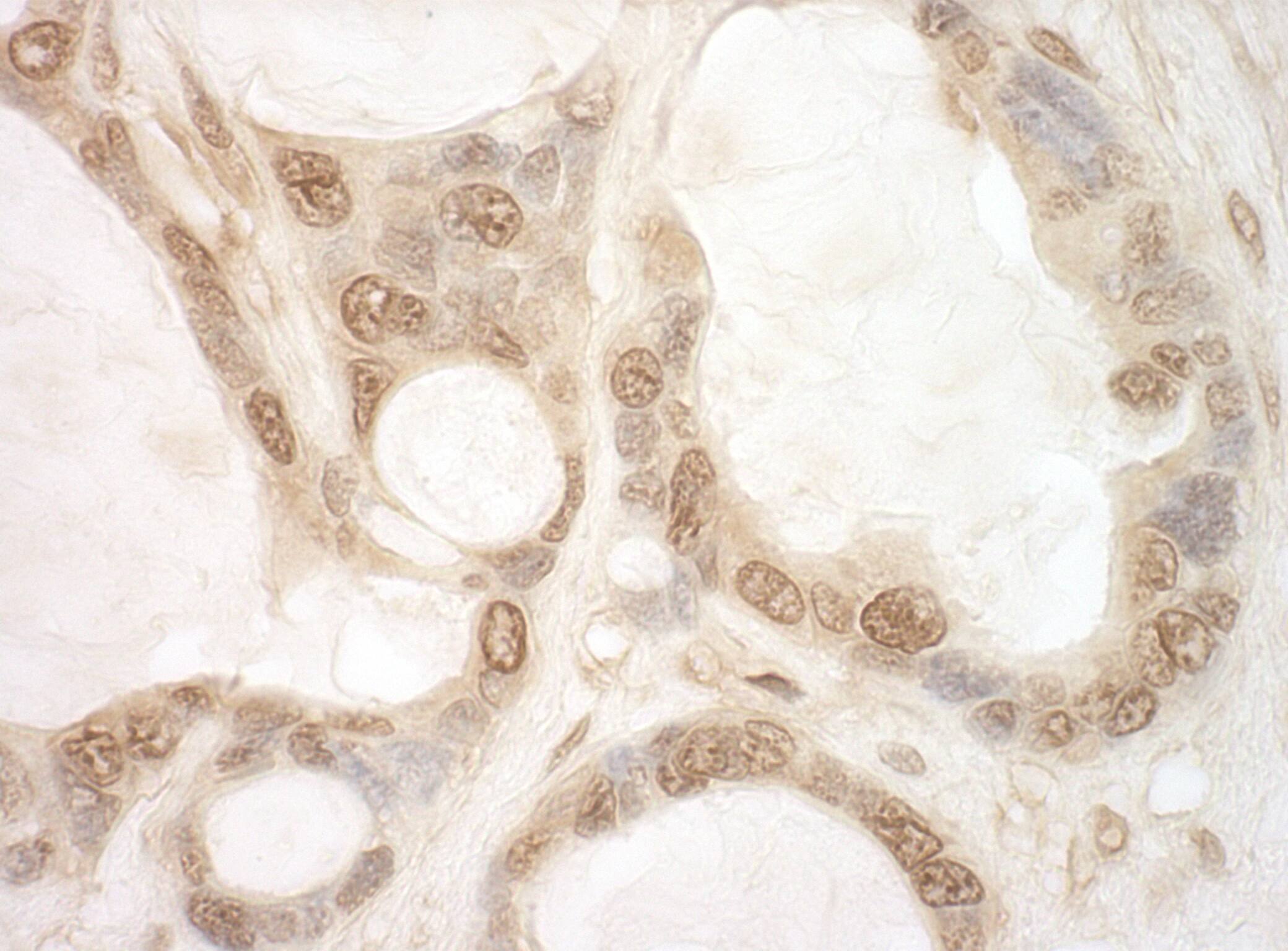 Immunohistochemistry:[NBP3-29291]-Detection of human eIF2B5 by immunohistochemistry. Sample: FFPE section of human ovarian carcinoma. Antibody: Affinity purified rabbit anti-eIF2B5.