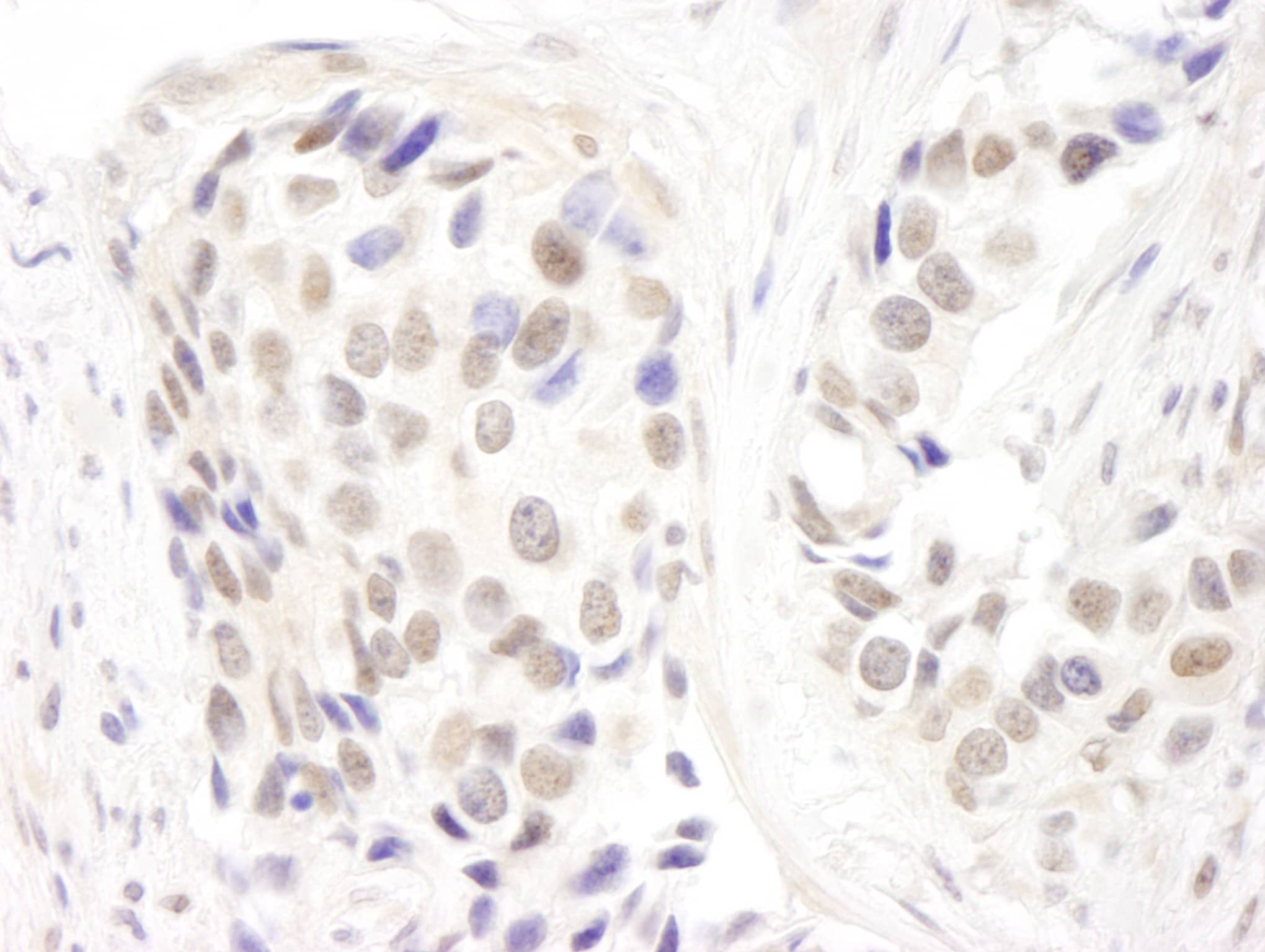 Immunohistochemistry:[NBP3-29298]-Detection of human p66alpha by immunohistochemistry. Sample: FFPE section of human breast carcinoma. Antibody: Affinity purified rabbit.