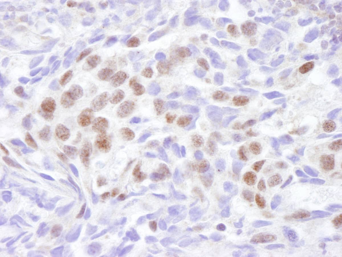 Immunohistochemistry:[NBP3-29299]-Detection of human EDD1 by immunohistochemistry. Sample: FFPE section of human breast. Antibody: Affinity purified rabbit anti-EDD1.