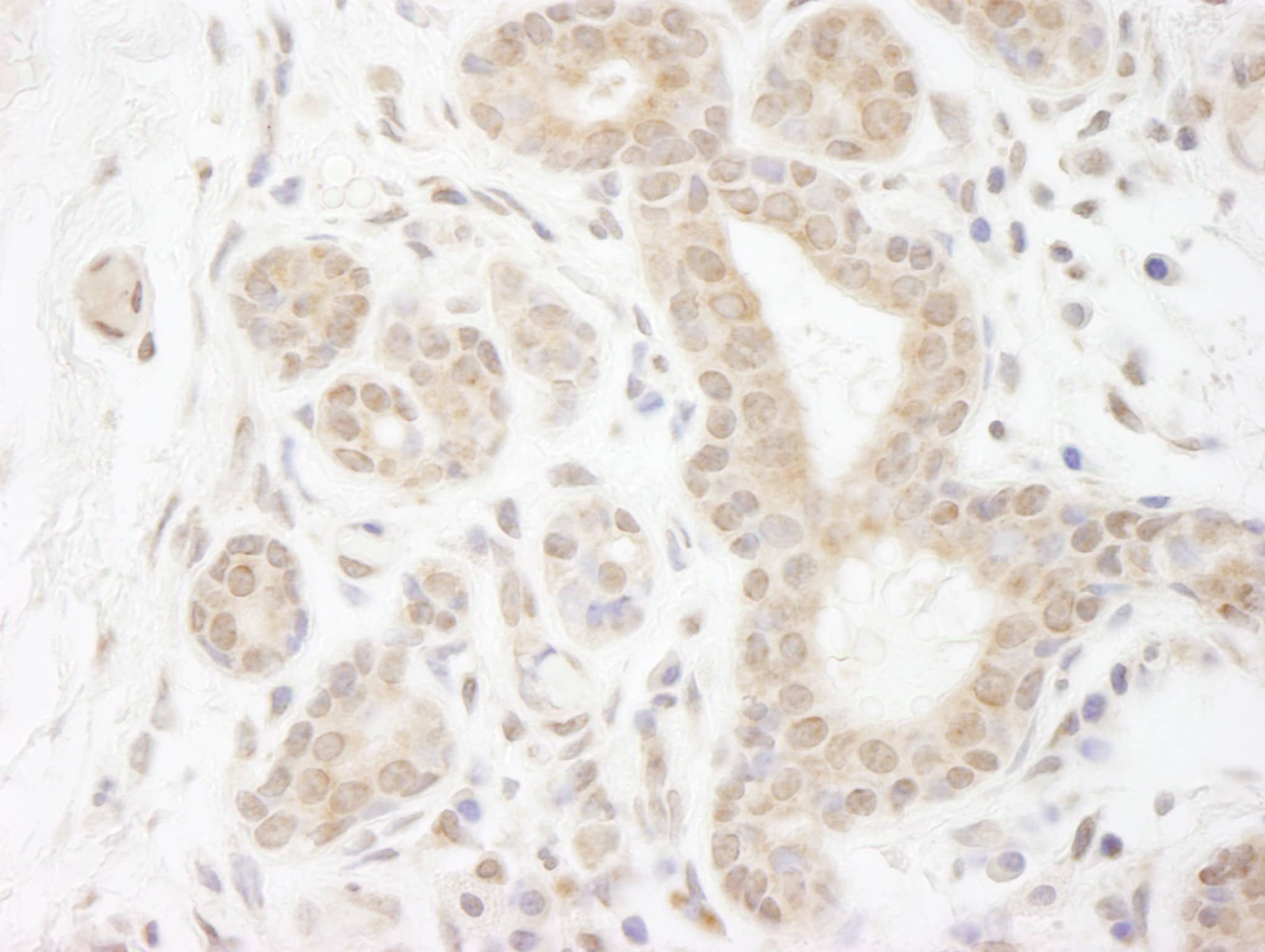 Immunohistochemistry:[NBP3-29300]-Detection of human DDX20 by immunohistochemistry. Sample: FFPE section of human breast carcinoma. Antibody: Affinity purified rabbit anti-DDX20.