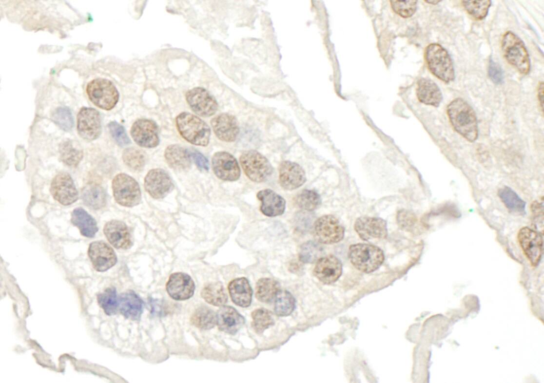 Immunohistochemistry:[NBP3-29305]-Detection of human BRD7 by immunohistochemistry. Sample: FFPE section of human prostate carcinoma. Antibody: Affinity purified rabbit anti-BRD7.