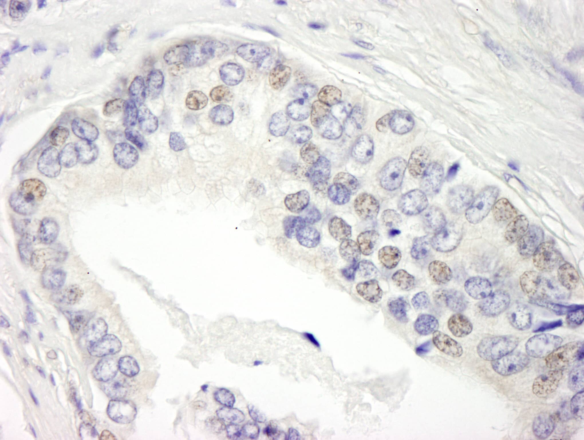 Immunohistochemistry:[NBP3-29307]-Detection of human BRD3 by immunohistochemistry. Sample: FFPE section of human prostate carcinoma. Antibody: Affinity purified rabbit anti-BRD3.