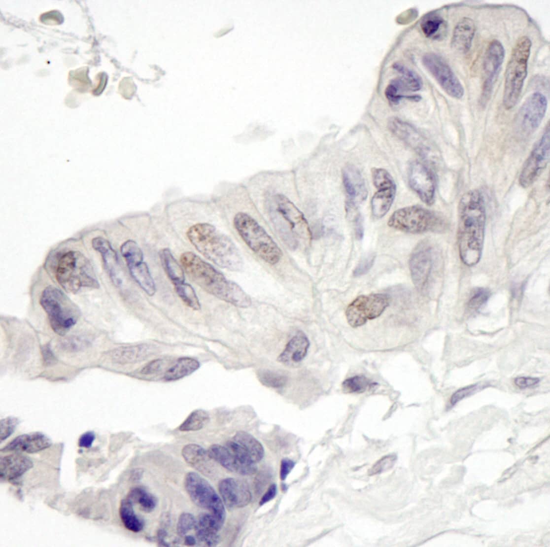 Immunohistochemistry:[NBP3-29309]-Detection of human MAML1 by immunohistochemistry. Sample: FFPE section of human ovarian carcinoma. Antibody: Affinity purified rabbit anti-MAML1.