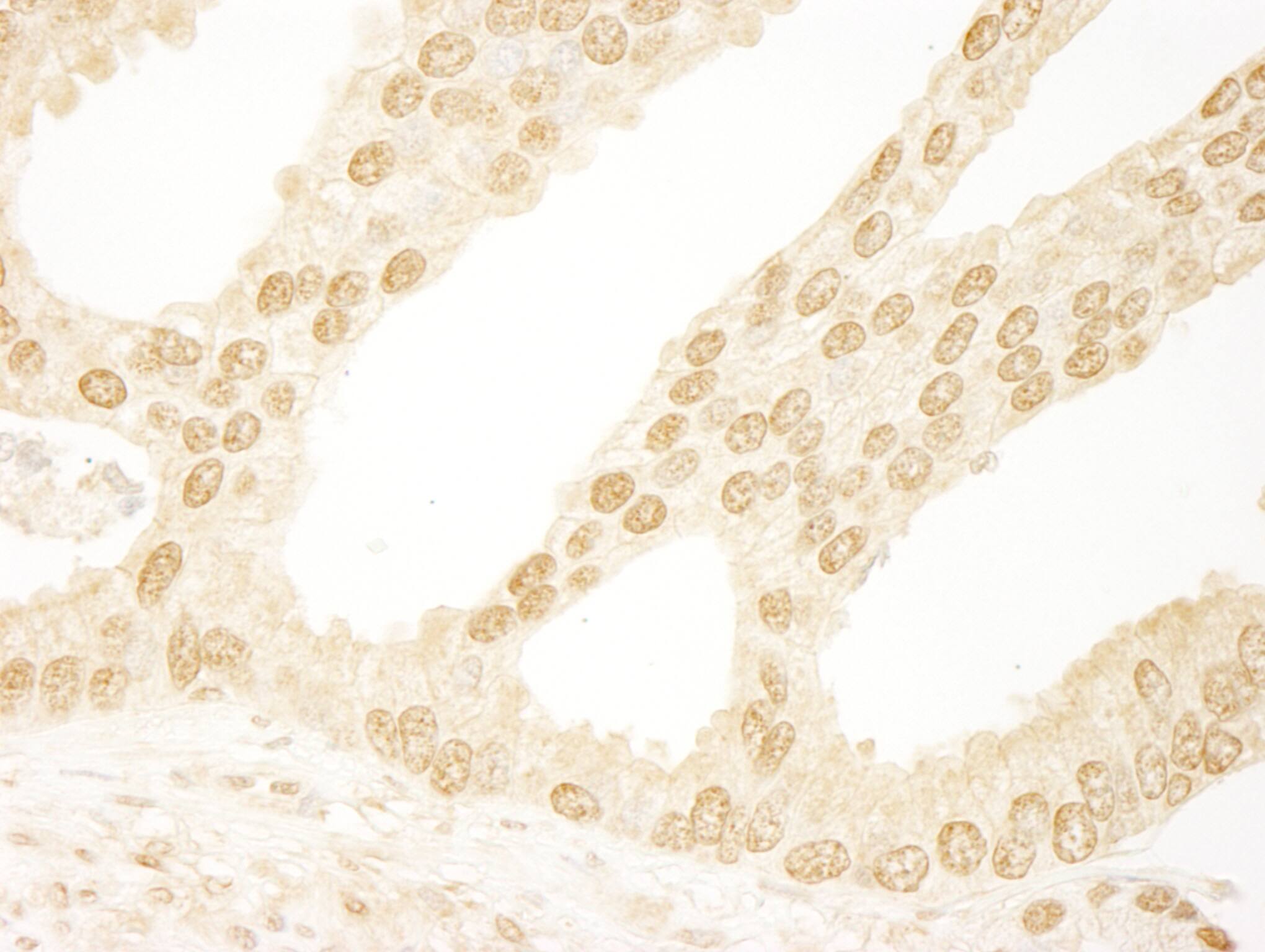 Immunohistochemistry:[NBP3-29315]-Detection of human DDX26/DICE1 by immunohistochemistry. Sample: FFPE section of human prostate carcinoma. Antibody: Affinity purified rabbit anti-DDX26/DICE1.