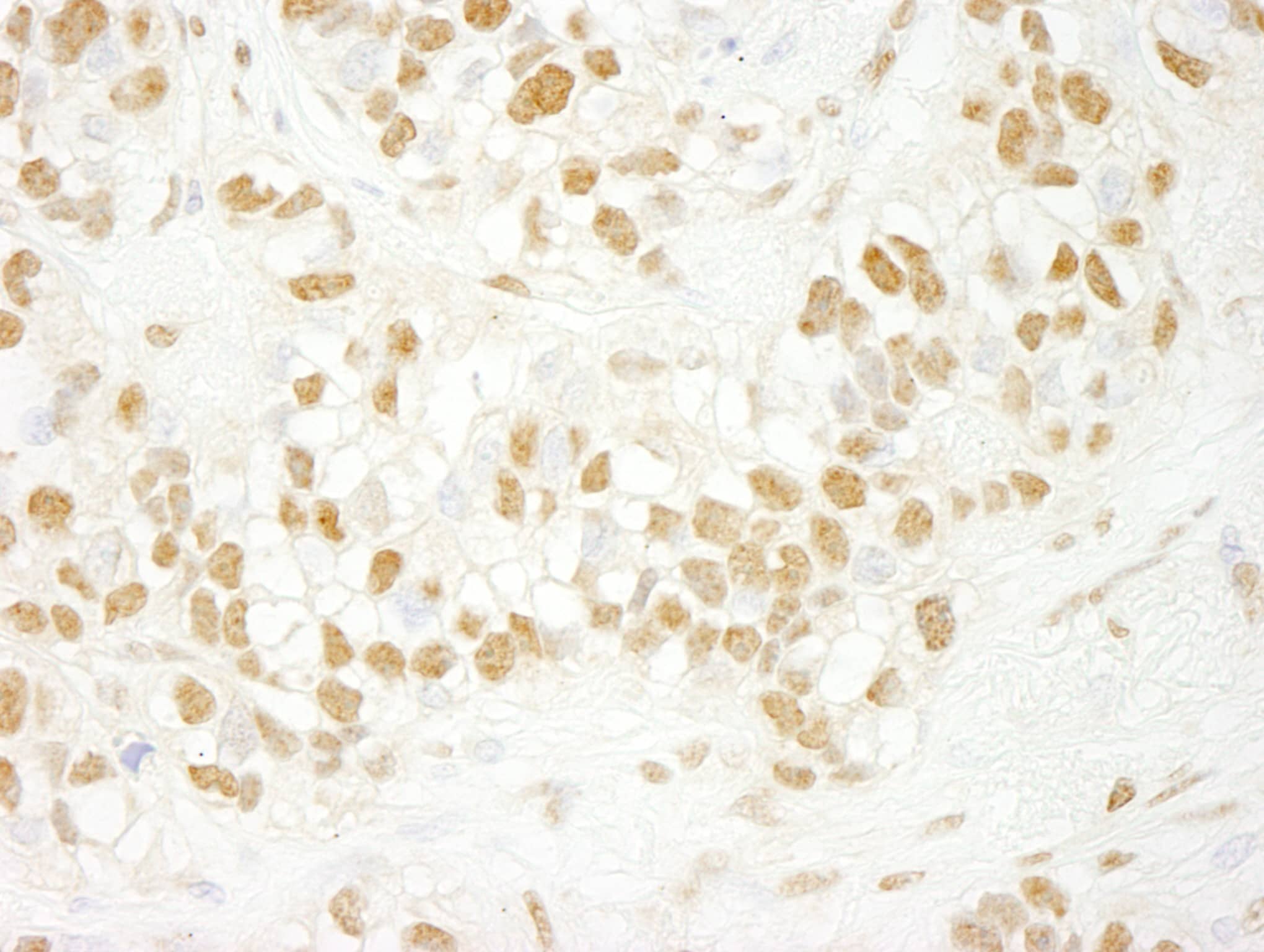 Immunohistochemistry:[NBP3-29317]-Detection of human CDC5L by immunohistochemistry. Sample: FFPE section of human breast carcinoma. Antibody: Affinity purified rabbit anti-CDC5L.