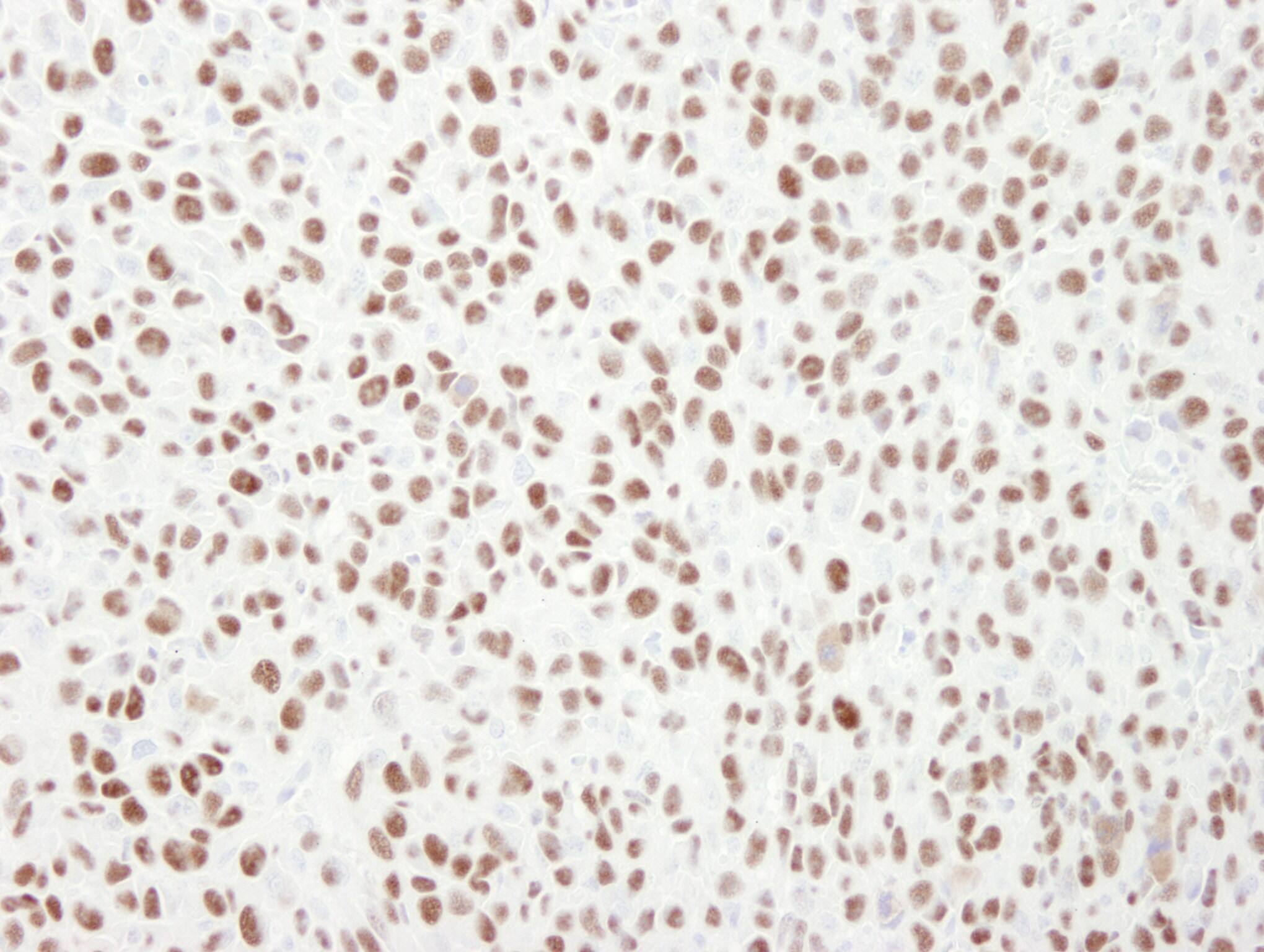 Immunohistochemistry:[NBP3-29319]-Detection of mouse MCM6 by immunohistochemistry. Sample: FFPE section of mouse squamous cell carcinoma. Antibody: Affinity purified rabbit anti-MCM6.