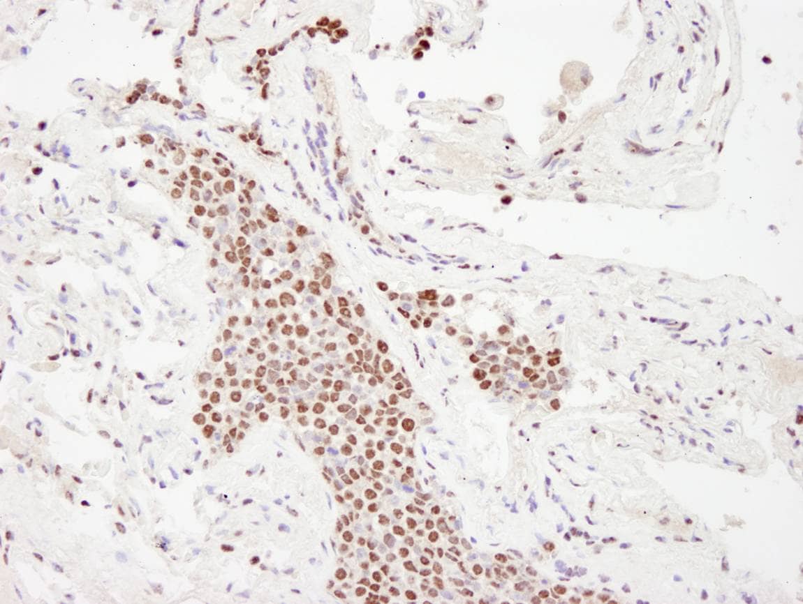 Immunohistochemistry:[NBP3-29325]-Detection of human p300 by immunohistochemistry. Samples: FFPE section of small cell lung carcinoma. Antibody: Affinity purified rabbit anti-p300.