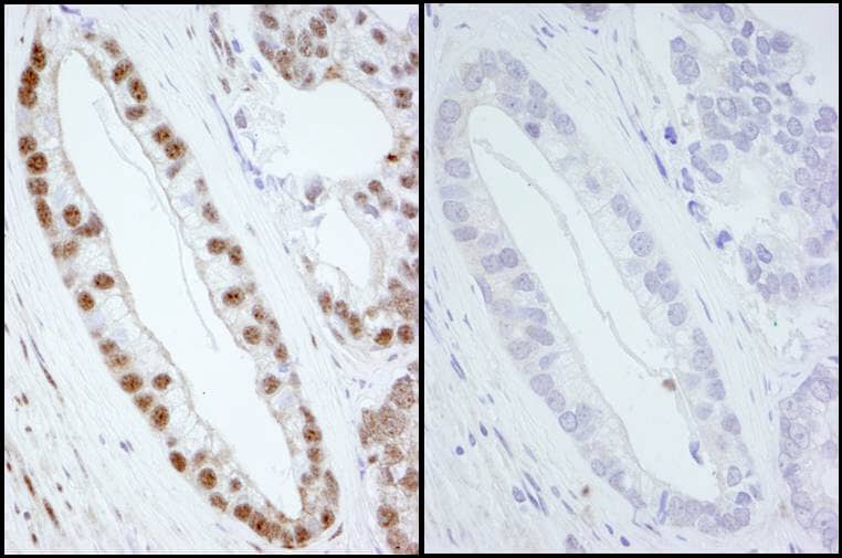 Immunohistochemistry:[NBP3-29326]-Detection of human Phospho SMC1 by immunohistochemistry. Samples: FFPE sections of human prostate carcinoma. Mock treatment or lambda phosphatase-treatment. Antibody: Affinity purified rabbit anti-Phospho-SMC1.