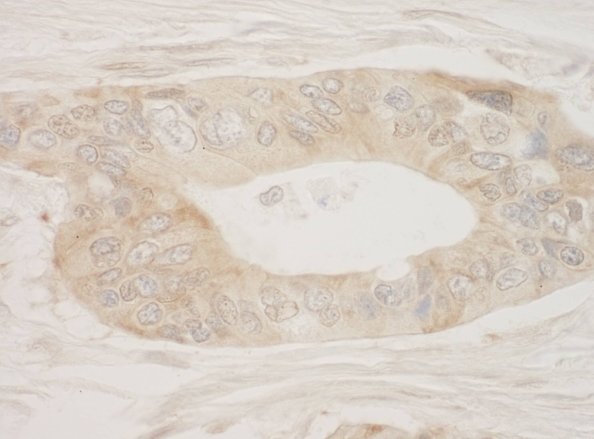 Immunohistochemistry:[NBP3-29328]-Detection of human RSK2 by immunohistochemistry. Sample: FFPE section of human ovarian carcinoma. Antibody: Affinity purified rabbit anti-RSK2.