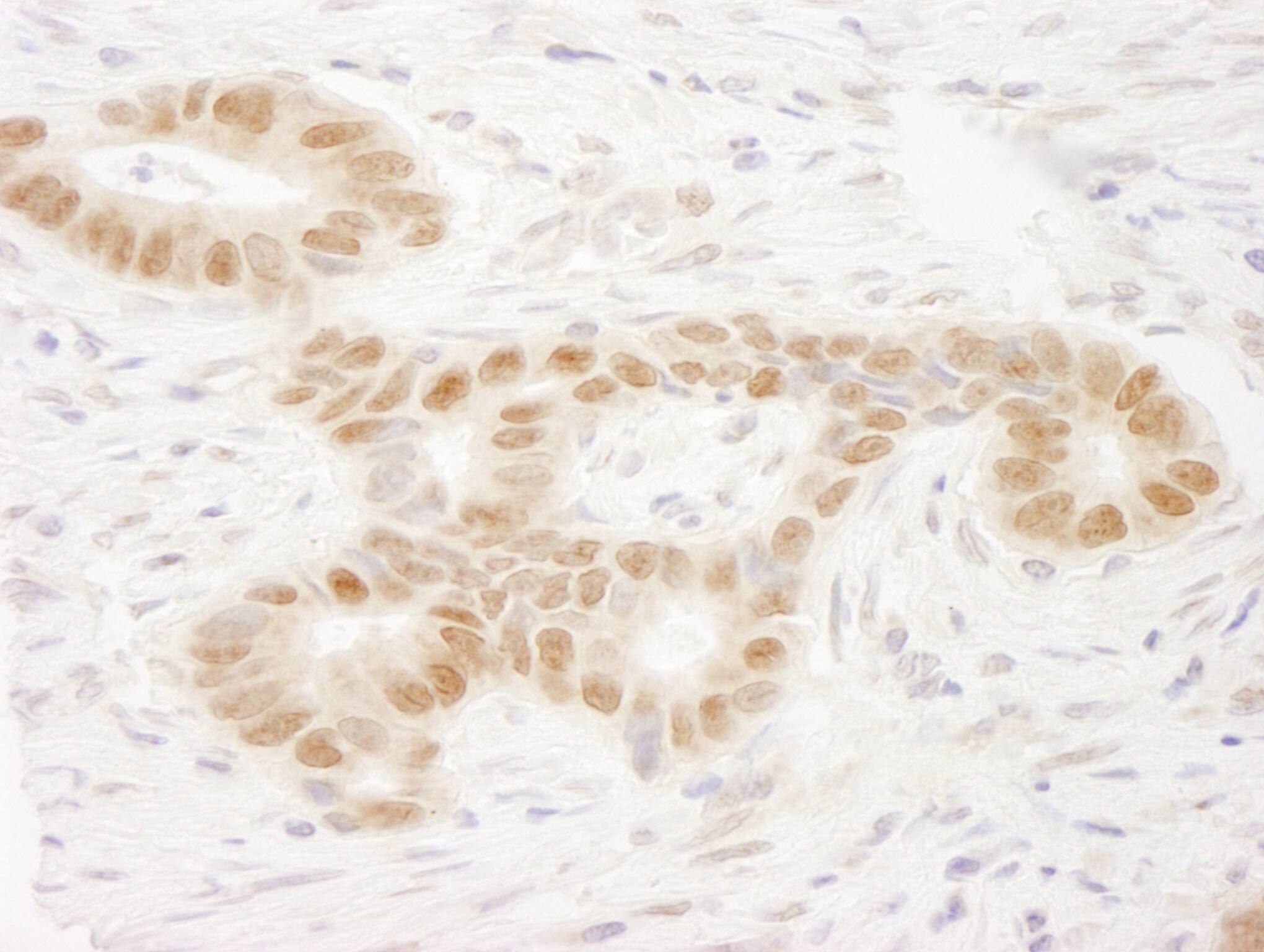 Immunohistochemistry:[NBP3-29329]-Detection of human MAML2 by immunohistochemistry. Sample: FFPE section of human stomach carcinoma. Antibody: Affinity purified rabbit anti-MAML2.