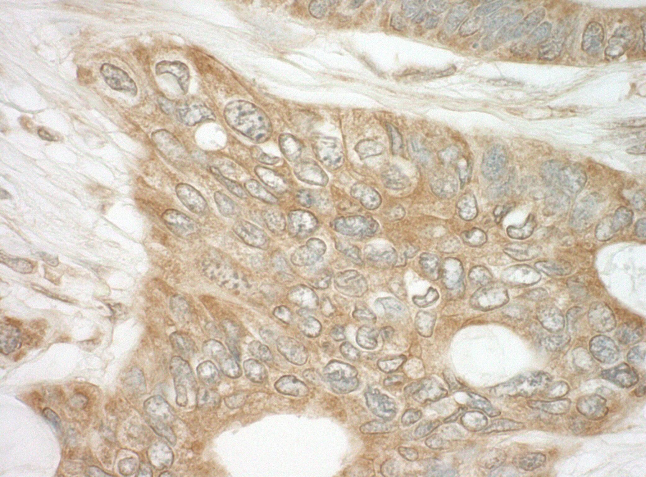 Immunohistochemistry:[NBP3-29330]-Detection of human DAP5 by immunohistochemistry. Sample: FFPE section of human ovarian carcinoma. Antibody: Affinity purified rabbit anti-DAP5.