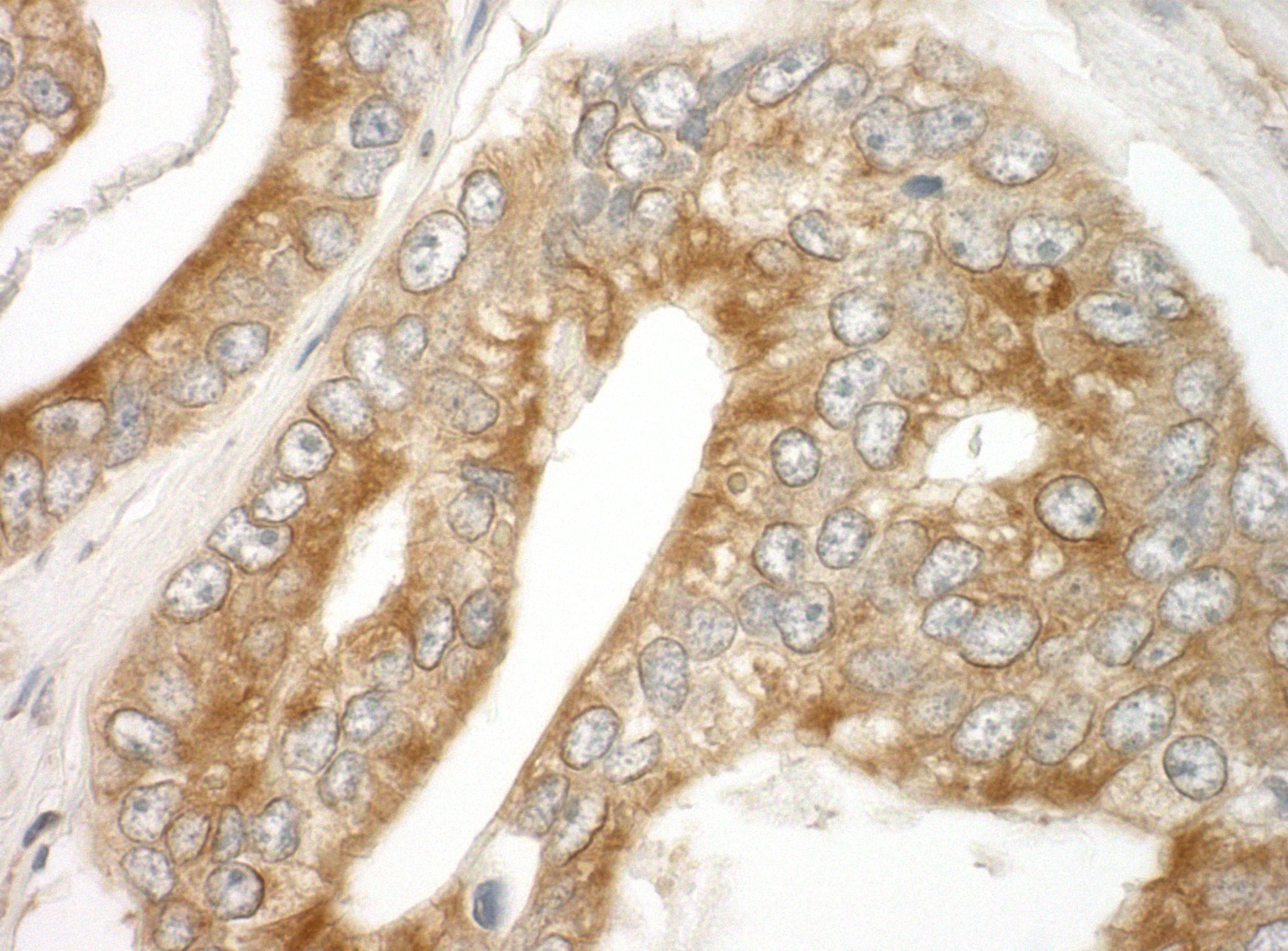 Immunohistochemistry:[NBP3-29334]-Detection of human EB1 by immunohistochemistry. Sample: FFPE section of human prostate carcinoma. Antibody: Affinity purified rabbit anti-EB1.