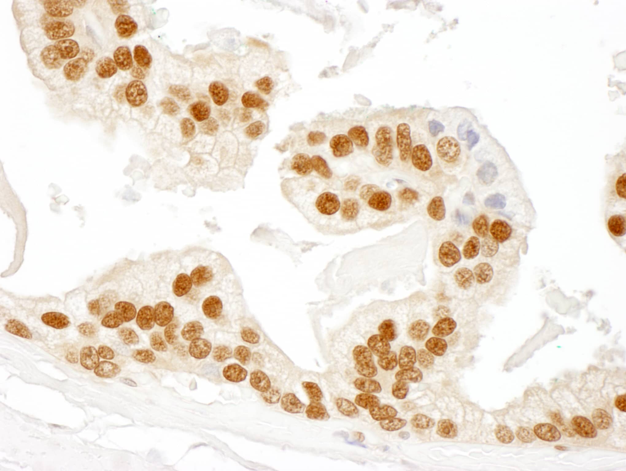 Immunohistochemistry:[NBP3-29336]-Detection of human RAD23B by immunohistochemistry. Sample: FFPE section of human prostate carcinoma. Antibody: Affinity purified rabbit anti-RAD23B.