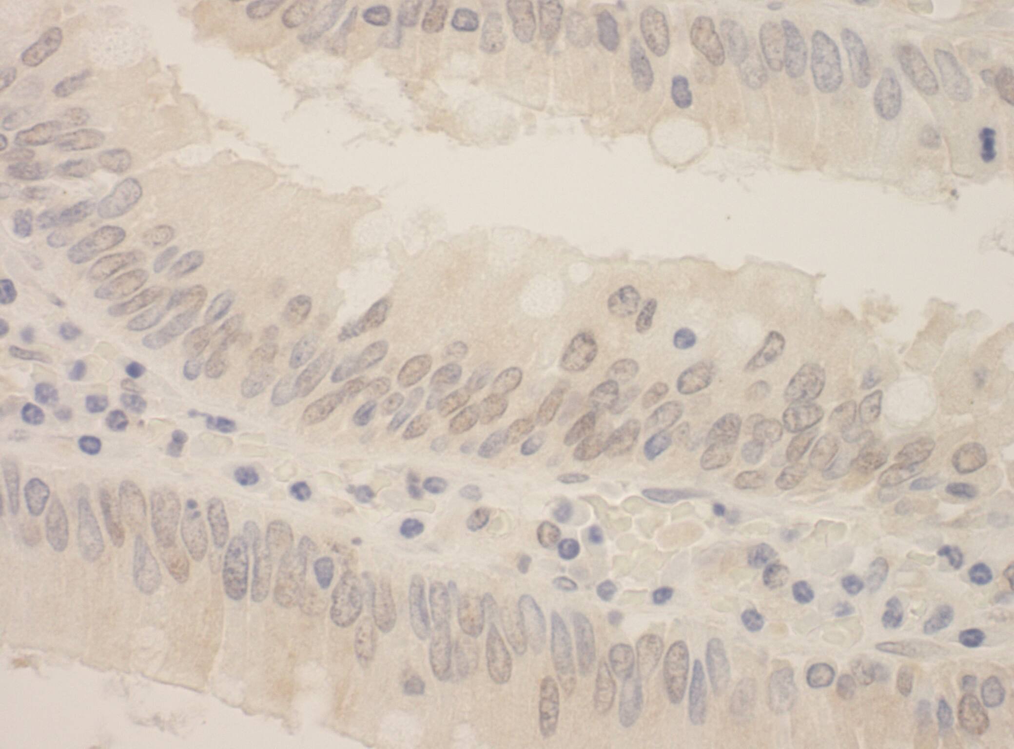 Immunohistochemistry:[NBP3-29337]-Detection of human SRPK2 by immunohistochemistry. Sample: FFPE section of human colon carcinoma. Antibody: Affinity purified rabbit anti-SRPK2.