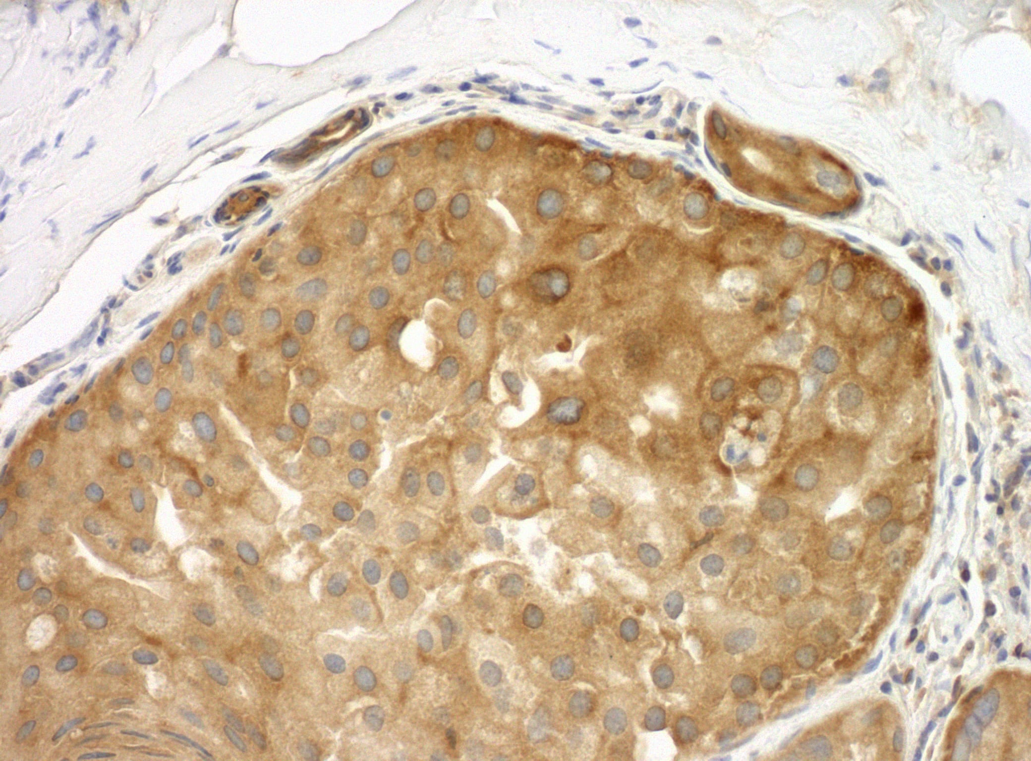 Immunohistochemistry:[NBP3-29338]-Detection of human Septin 9 by immunohistochemistry. Sample: FFPE section of human breast carcinoma. Antibody: Affinity purified rabbit anti-Septin 9.