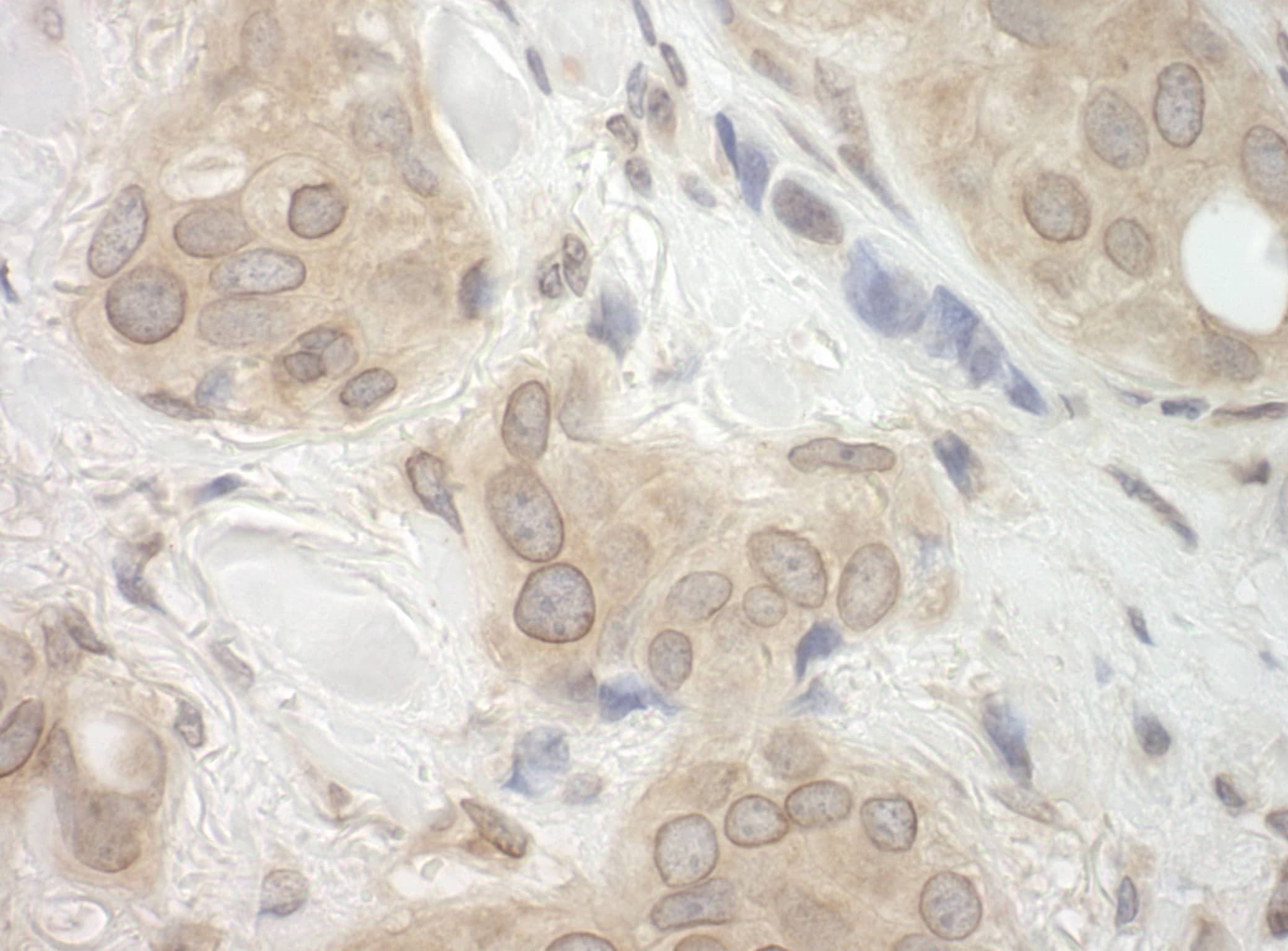 Immunohistochemistry:[NBP3-29340]-Detection of human CASC3 by immunohistochemistry. Sample: FFPE section of human breast carcinoma. Antibody: Affinity purified rabbit anti-CASC3.