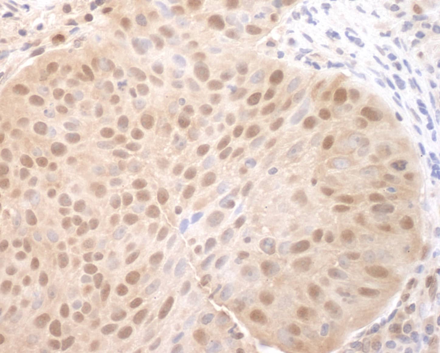 Immunohistochemistry;Cdc6 Antibody[NBP3-29180]Detection of human CDC6 by immunohistochemistry. Sample: FFPE section of human lung carcinoma. Antibody: Affinity purified rabbit anti-CDC6  used at a dilution of 1:1,000 . Detection: DAB