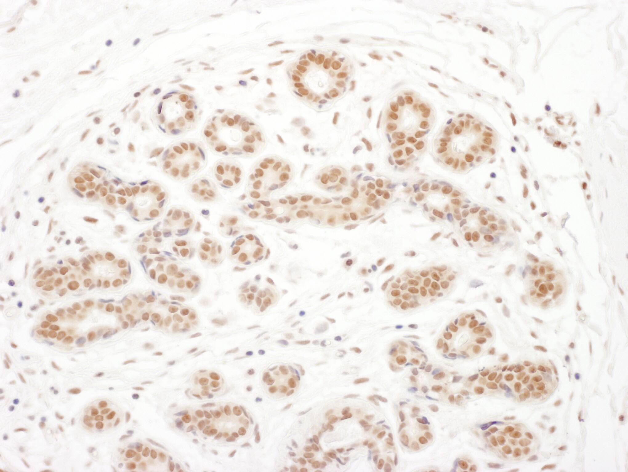 Immunohistochemistry;RSK3 Antibody[NBP3-29467]Detection of human RSK3 by immunohistochemistry. Sample: FFPE section of human breast carcinoma. Antibody: Affinity purified rabbit anti-RSK3  used at a dilution of 1:1,000 . Detection: DAB. Counterstain: IHC Hematoxylin .