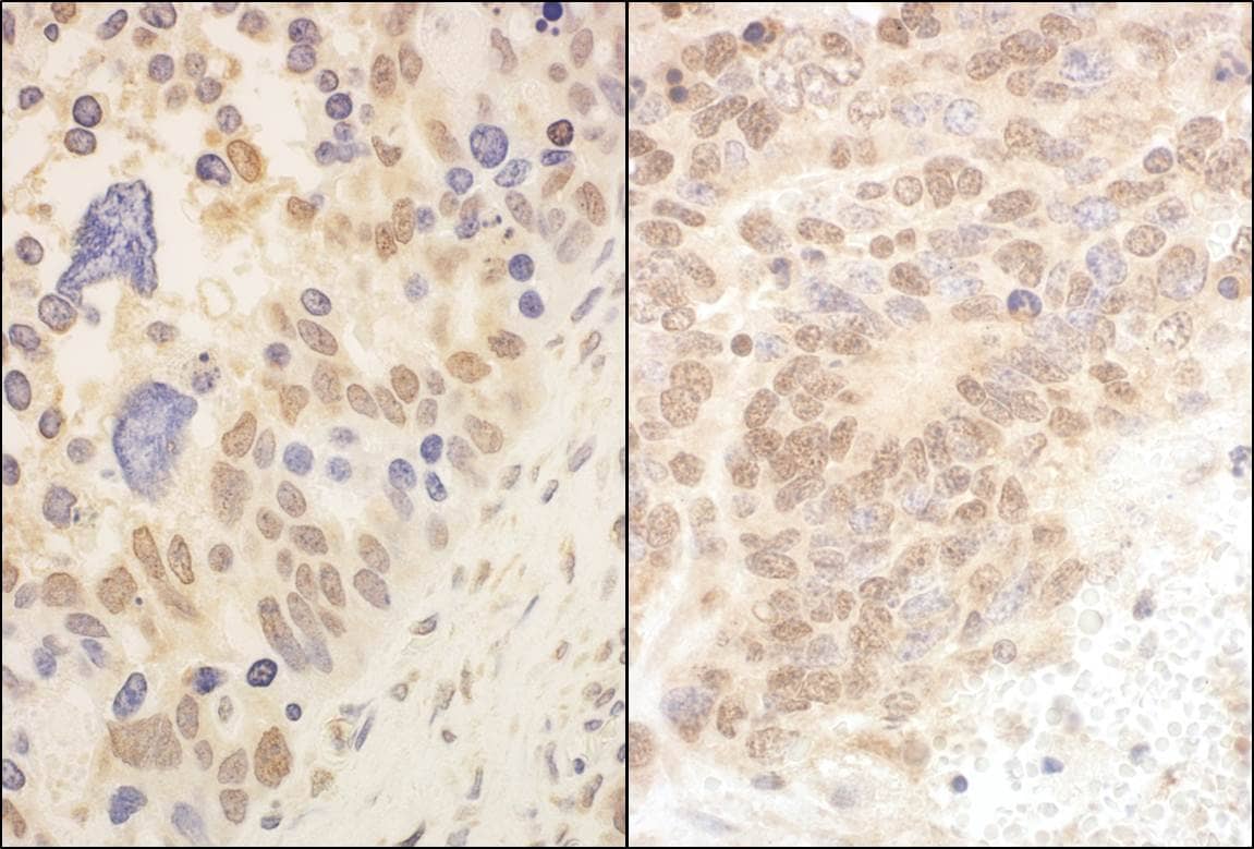 Immunohistochemistry;Cullin 2 Antibody[NBP3-29470]Detection of human and mouse Cul2 by immunohistochemistry. Sample: FFPE section of human ovarian carcinoma  and mouse teratoma . Antibody: Affinity purified rabbit anti-Cul2  used at a dilution of 1:5,000  and 1:1,000 . Detection: DAB