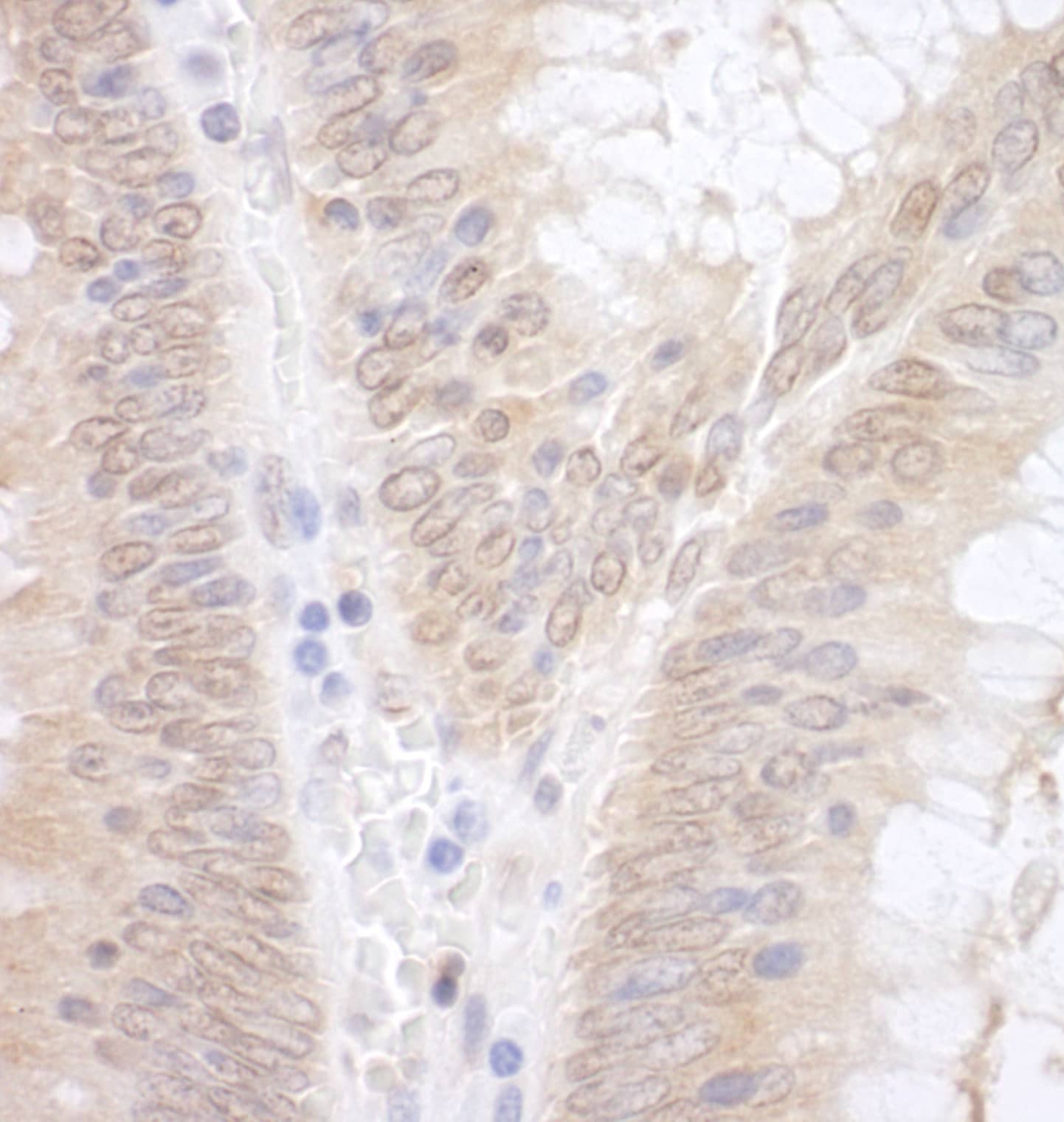 Immunohistochemistry;EAF2 Antibody[NBP3-29471]Detection of human EAF2 by immunohistochemistry. Sample: FFPE section of human colon carcinoma. Antibody: Affinity purified rabbit anti-EAF2  used at a dilution of 1:1,000 . Detection: DAB