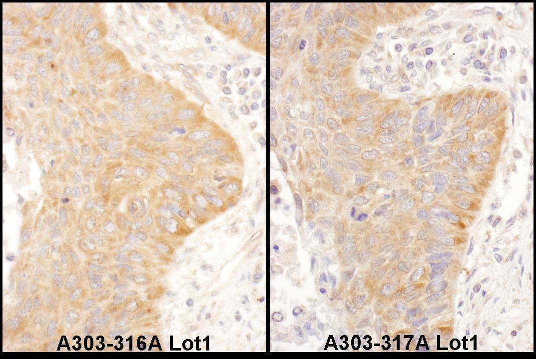 Immunohistochemistry;IMP2/IGF2BP2 Antibody[NBP3-29472]Detection of human IGF2BP2 by immunohistochemistry. Samples: FFPE serial sections of human non-small cell lung cancer. Antibody: Affinity purified rabbit anti-IGF2BP2  used at a dilution of 1:1,000 . Detection: DAB