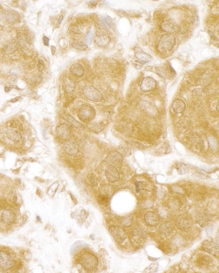 Immunohistochemistry;MERIT40/HSPC142 Antibody[NBP3-29473]Detection of human MERIT40 by immunohistochemistry. Sample: FFPE section of human breast carcinoma. Antibody: Affinity purified rabbit anti-MERIT40  used at a dilution of 1:1,000 . Detection: DAB