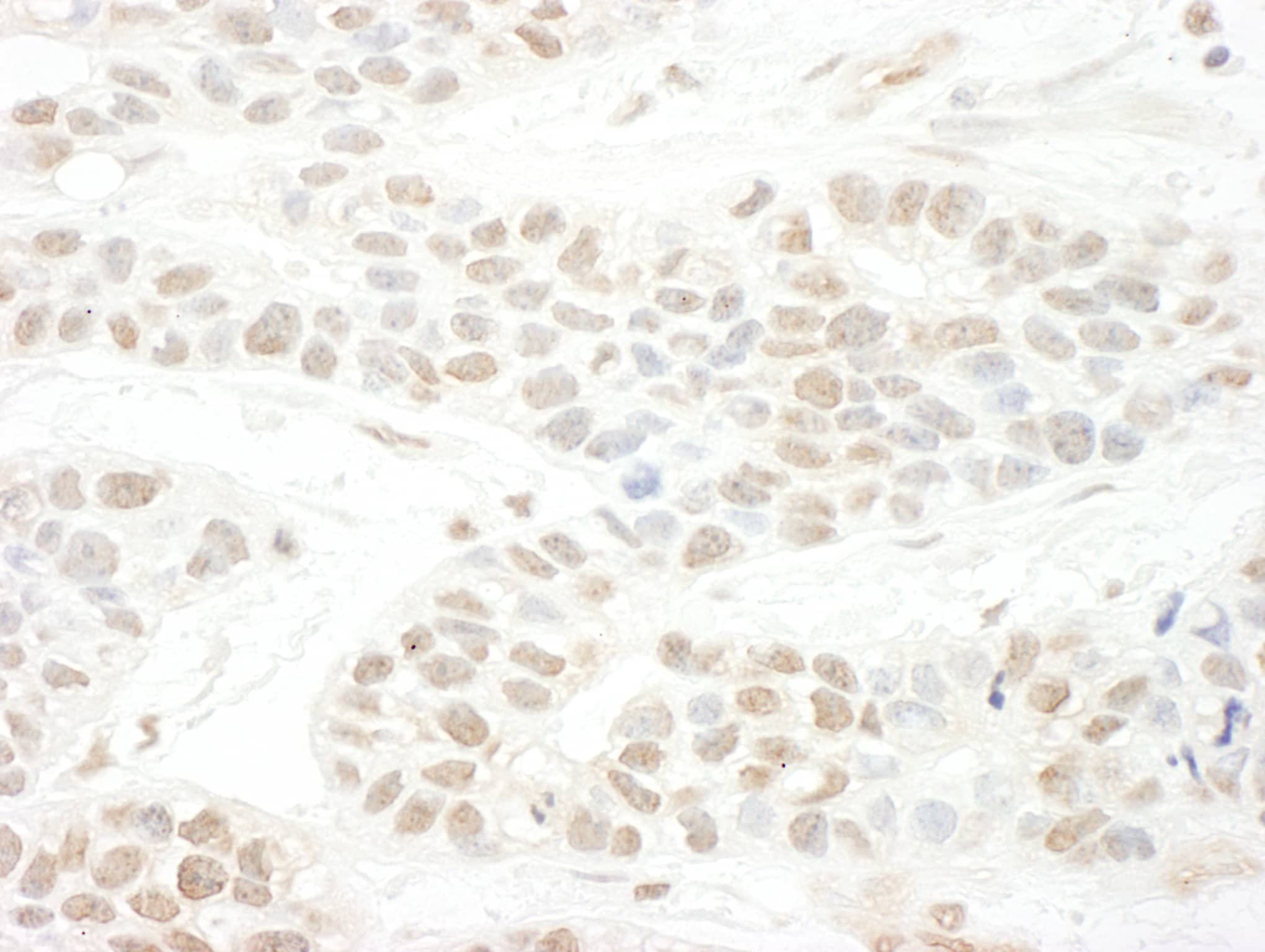 Immunohistochemistry;SLX4 Antibody[NBP3-29476]Detection of human BTBD12 by immunohistochemistry. Sample: FFPE section of human breast carcinoma. Antibody: Affinity purified rabbit anti-BTBD12  used at a dilution of 1:1,000 . Detection: DAB