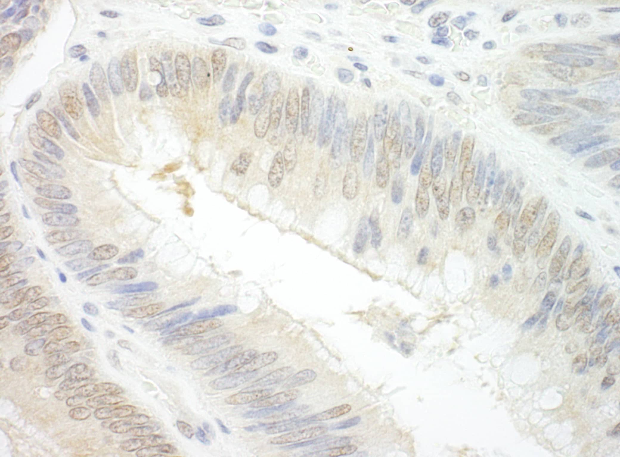 Immunohistochemistry;EAF2 Antibody[NBP3-29479]Detection of human EAF2 by immunohistochemistry. Sample: FFPE section of human colon carcinoma. Antibody: Affinity purified rabbit anti-EAF2  used at a dilution of 1:1,000 . Detection: DAB